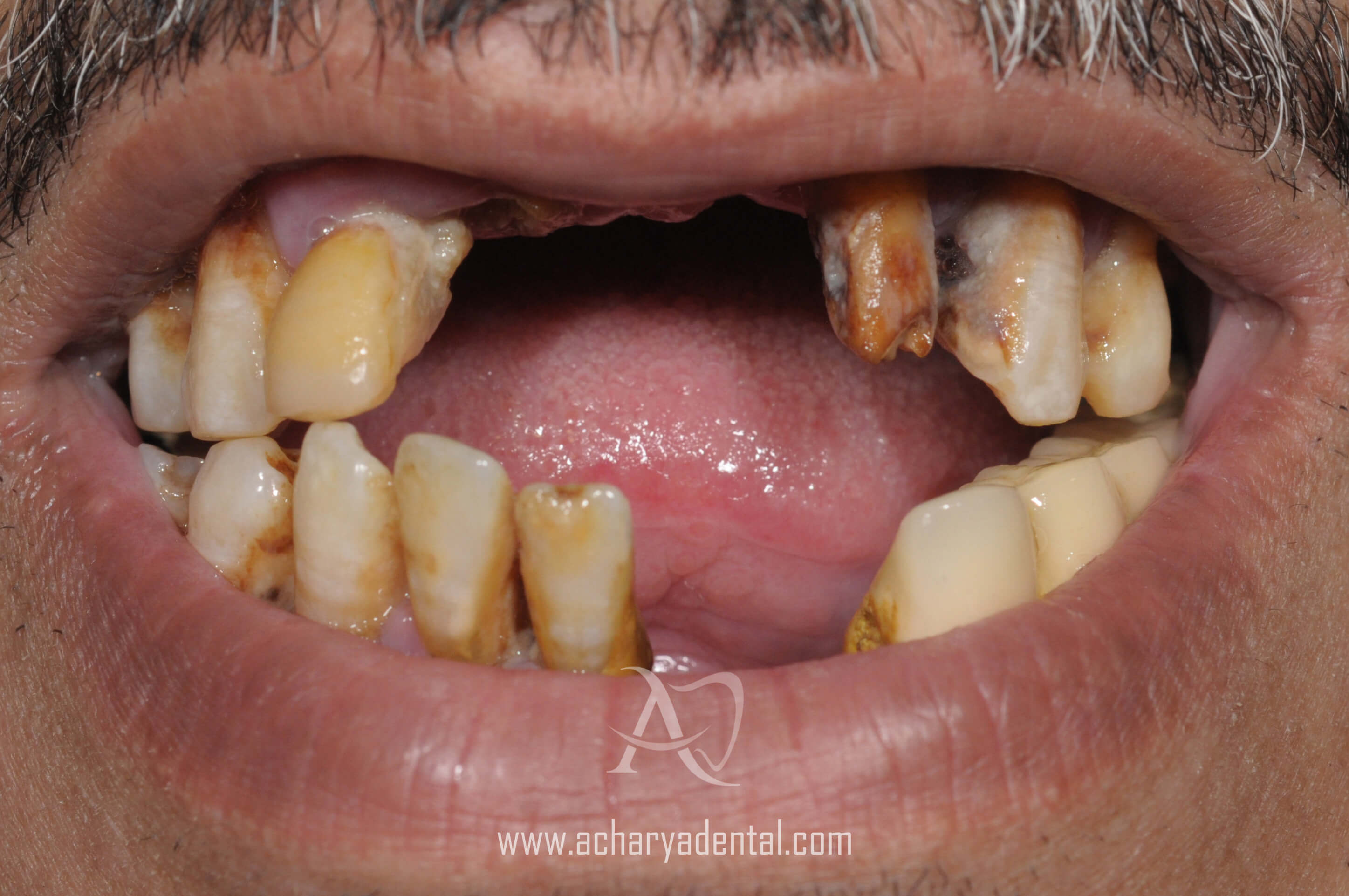 before dental implant