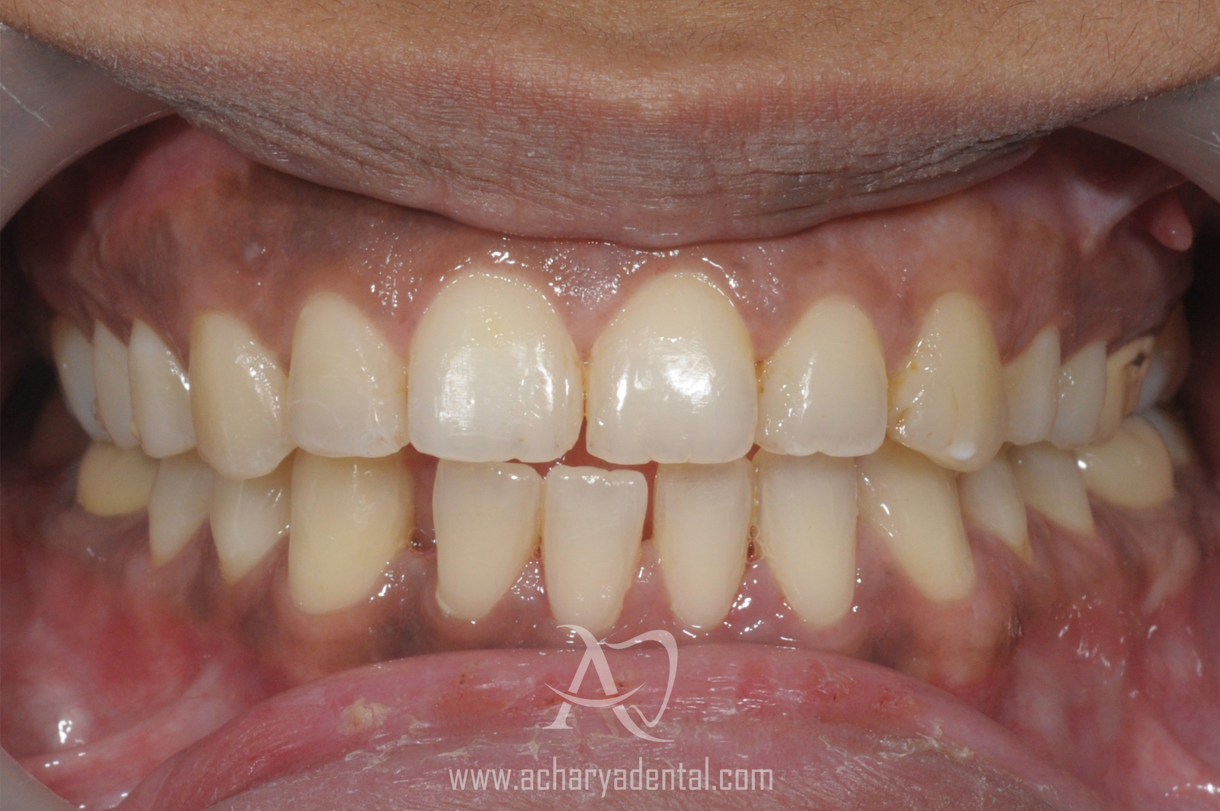 before ortho treatment