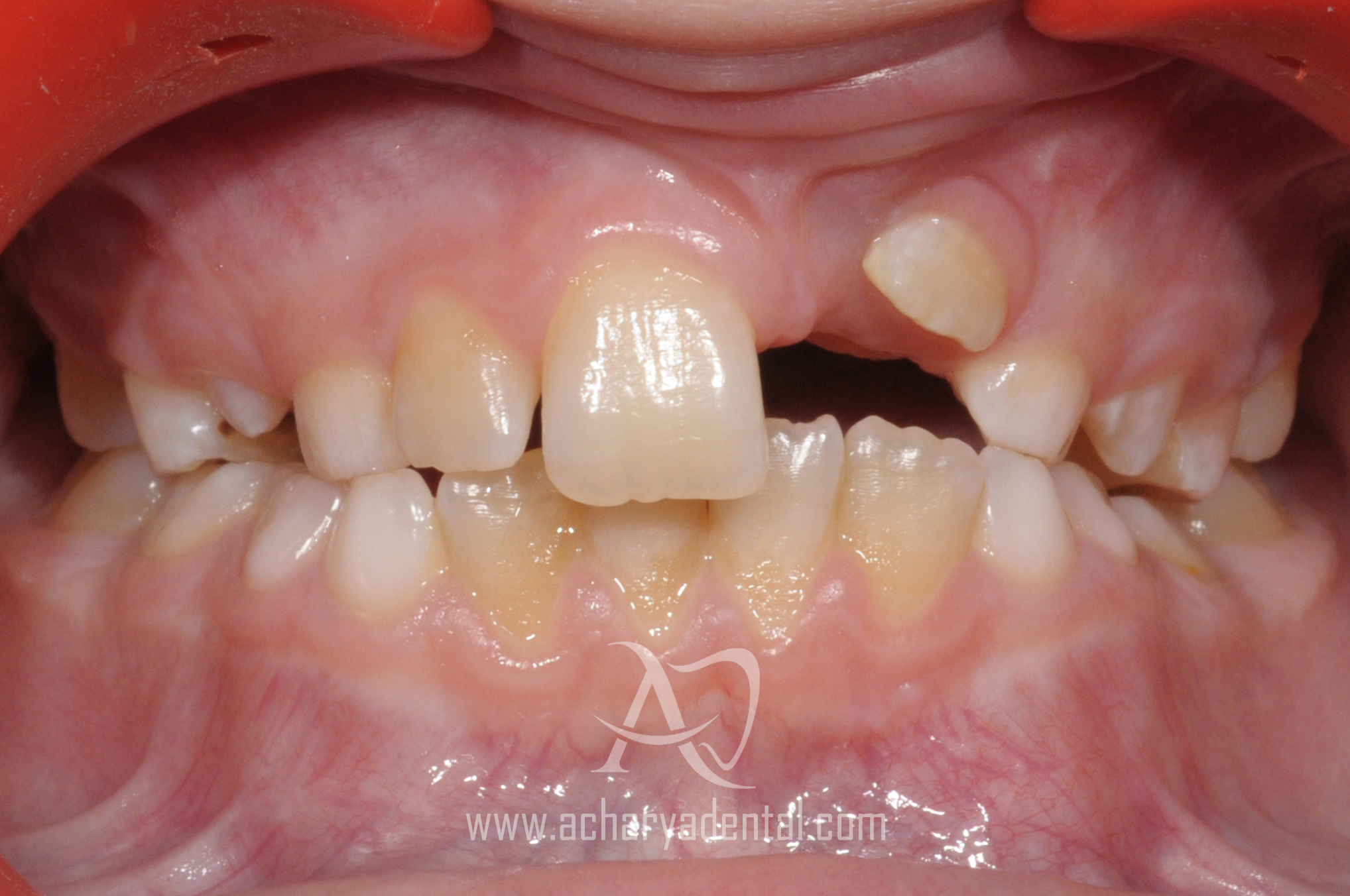 before orthodontics