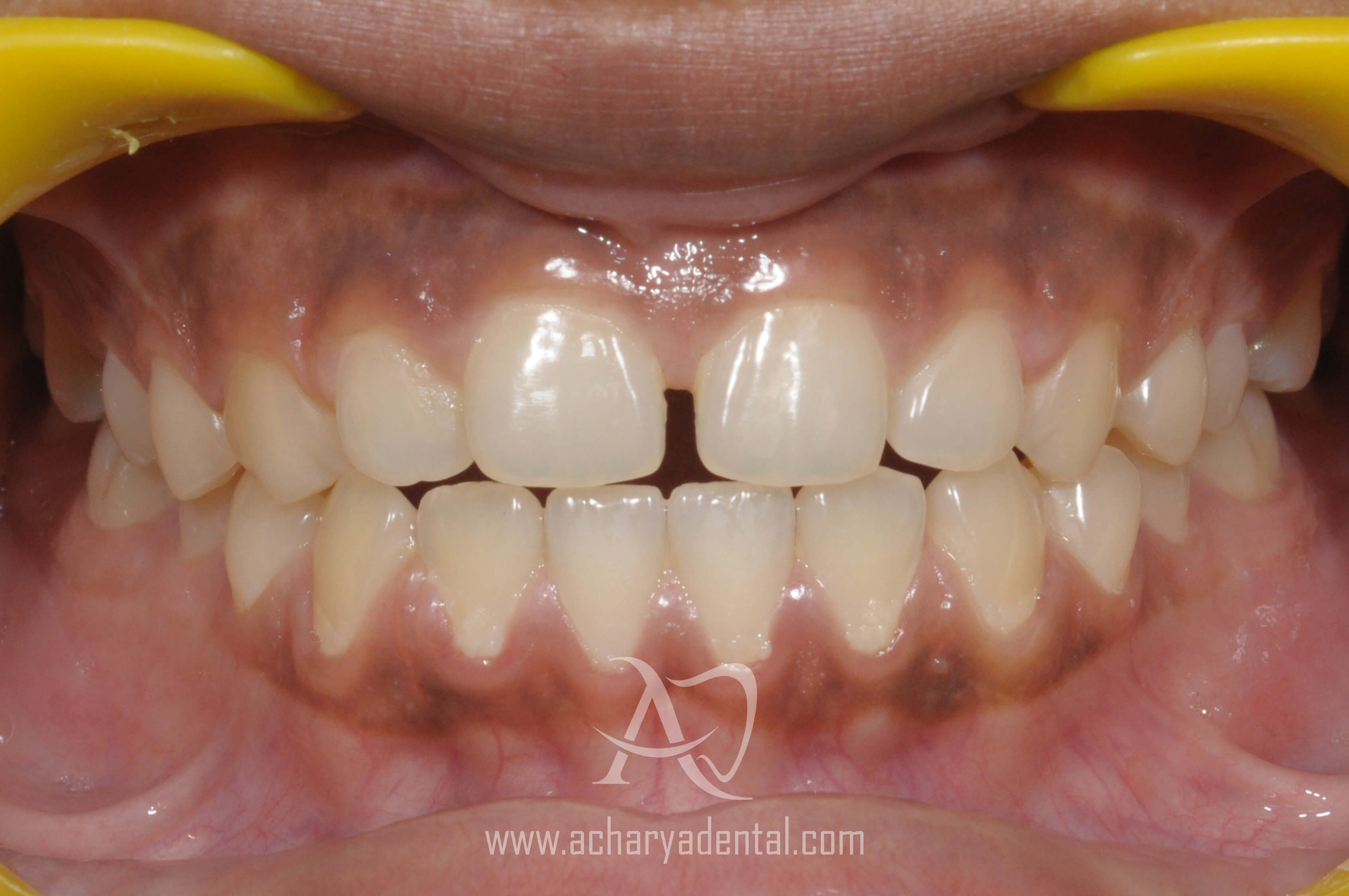 before orthodontics