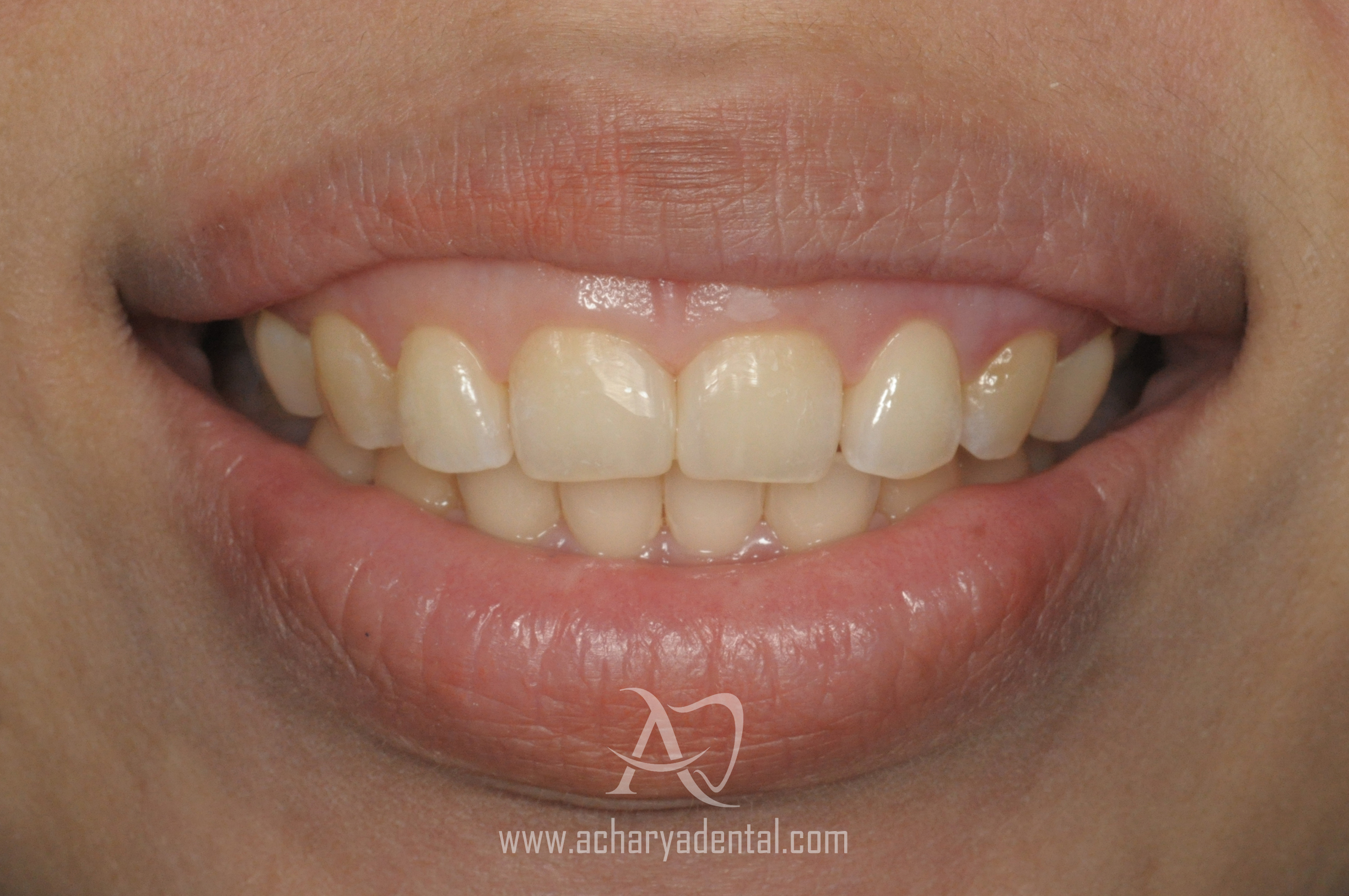 before smile make over