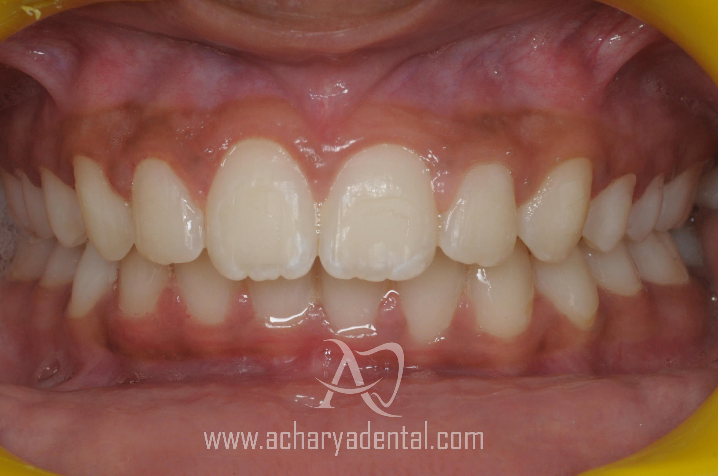 orthodontics treatment after