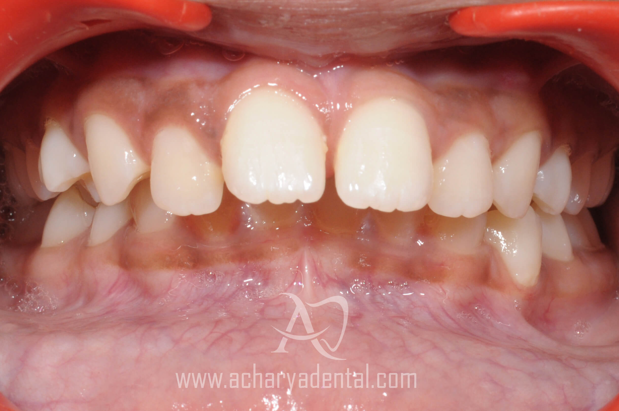 orthodontics treatment before