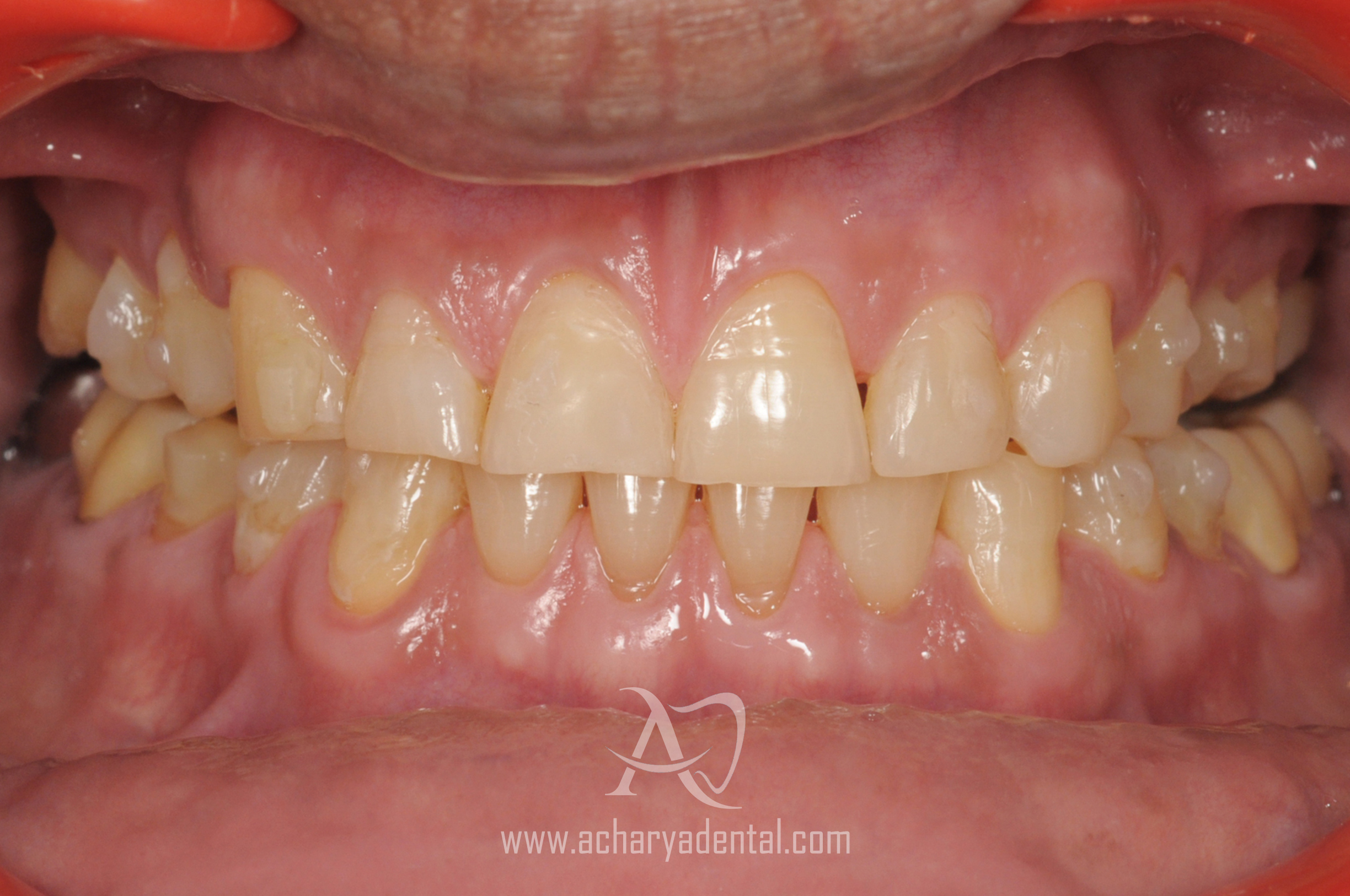ortho treatment after
