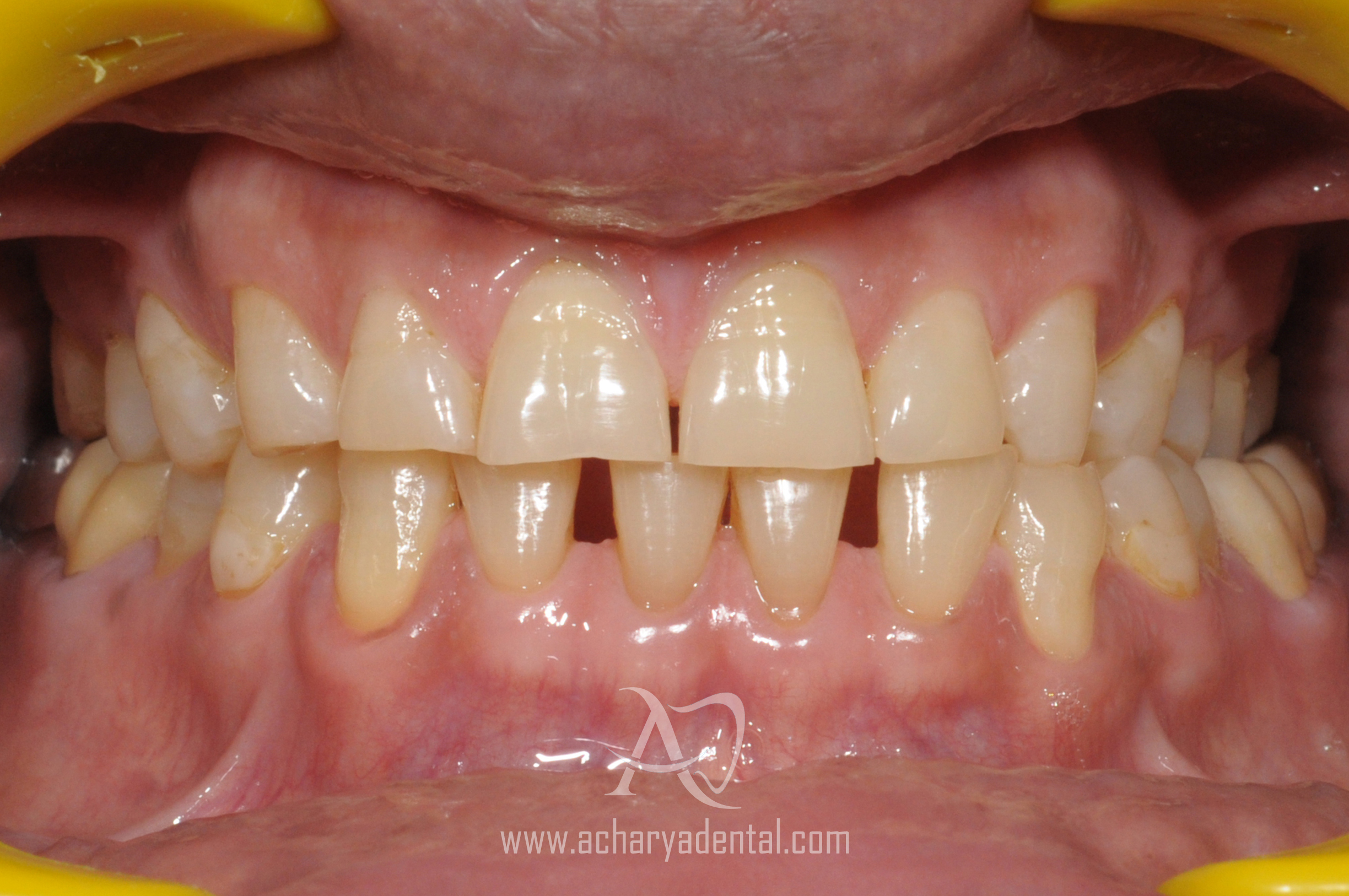 ortho treatment before