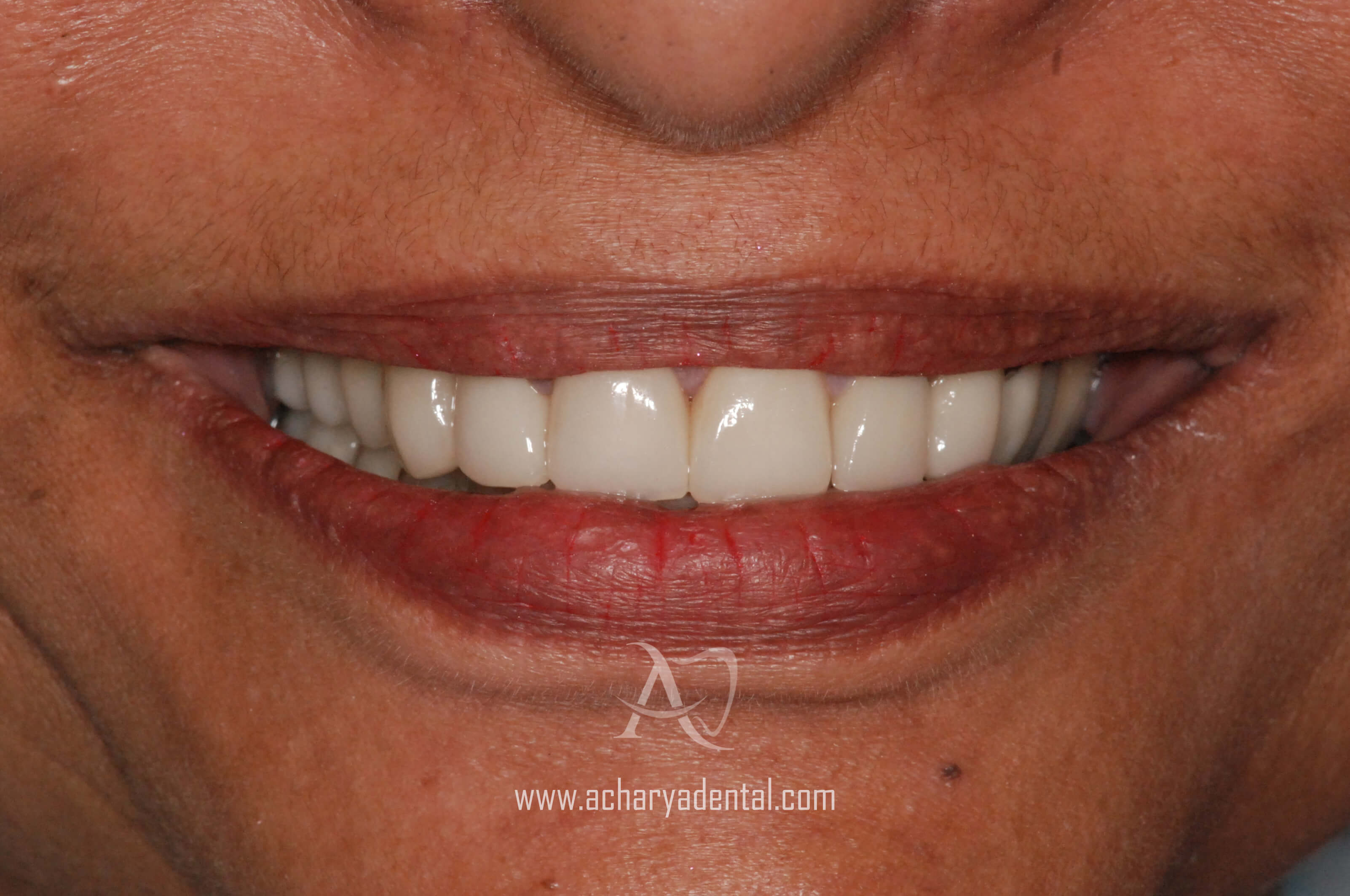 post dental implant treatment