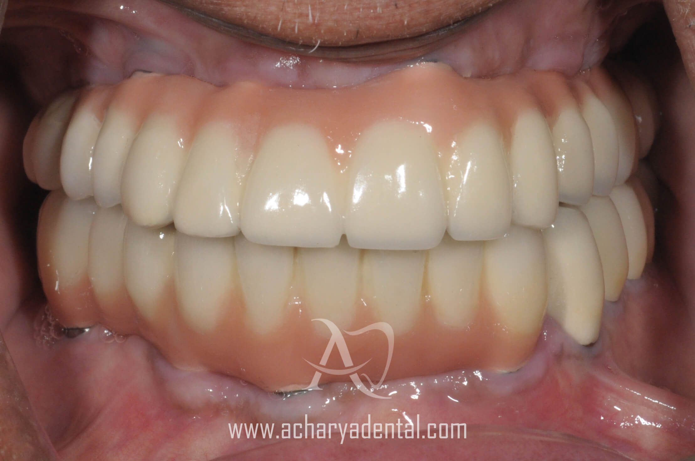 post dental implant