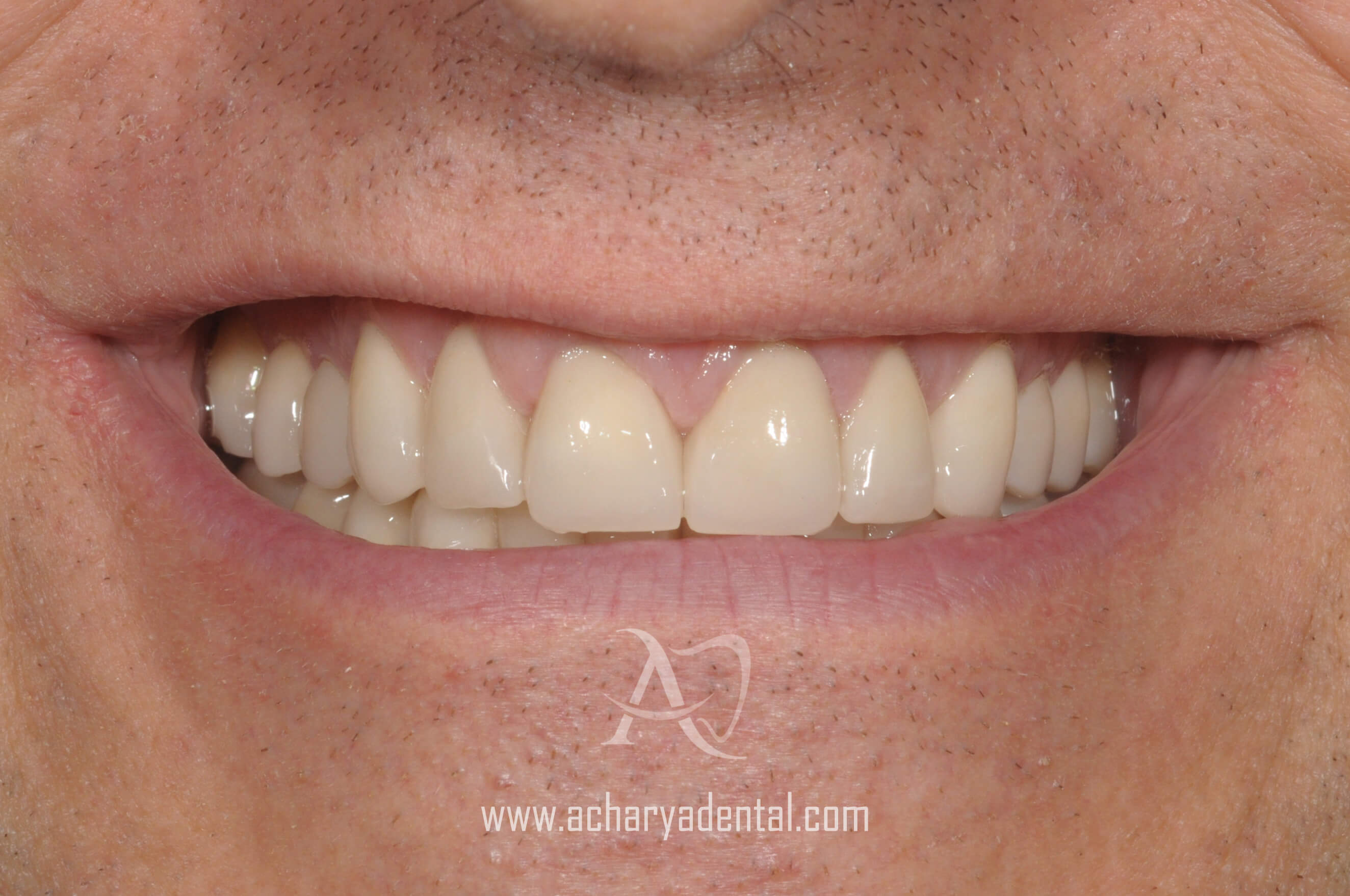 post full mouth rehabilitation treatment