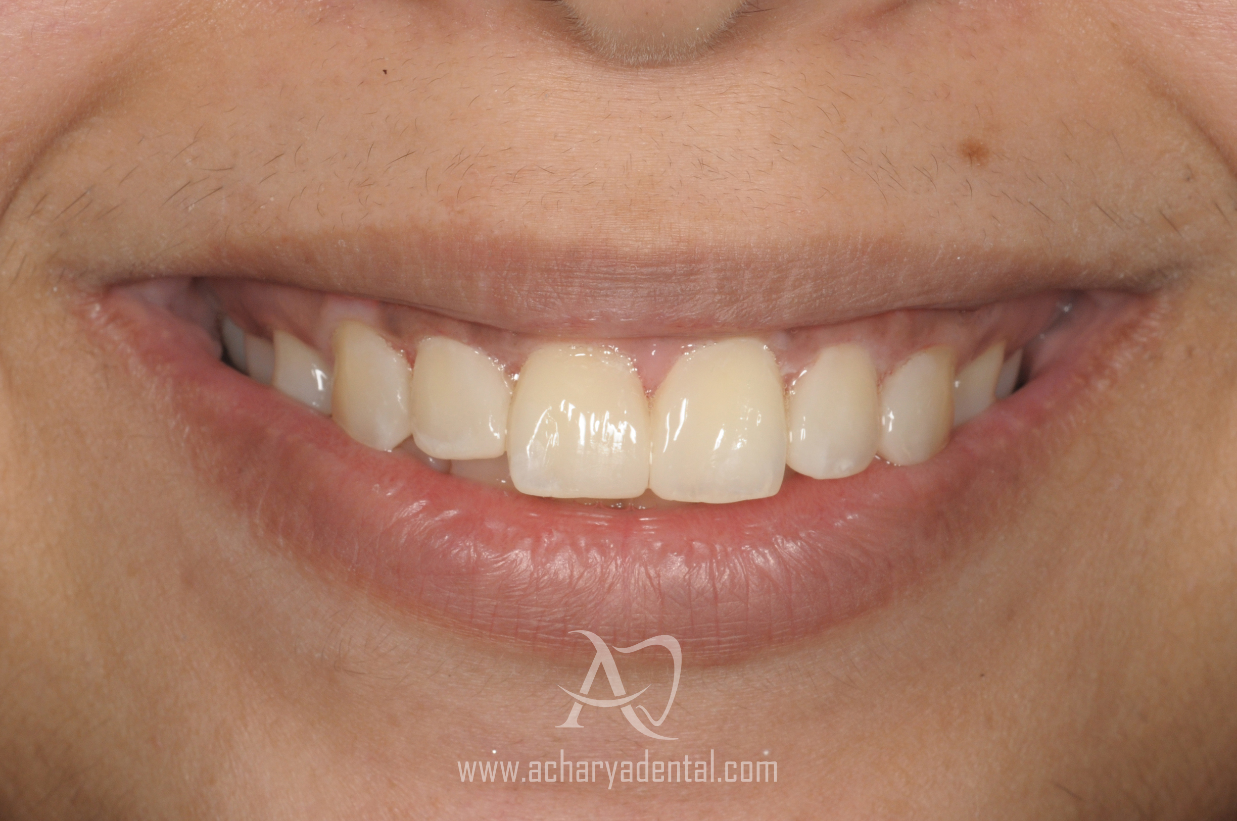 post smile makeover treatment