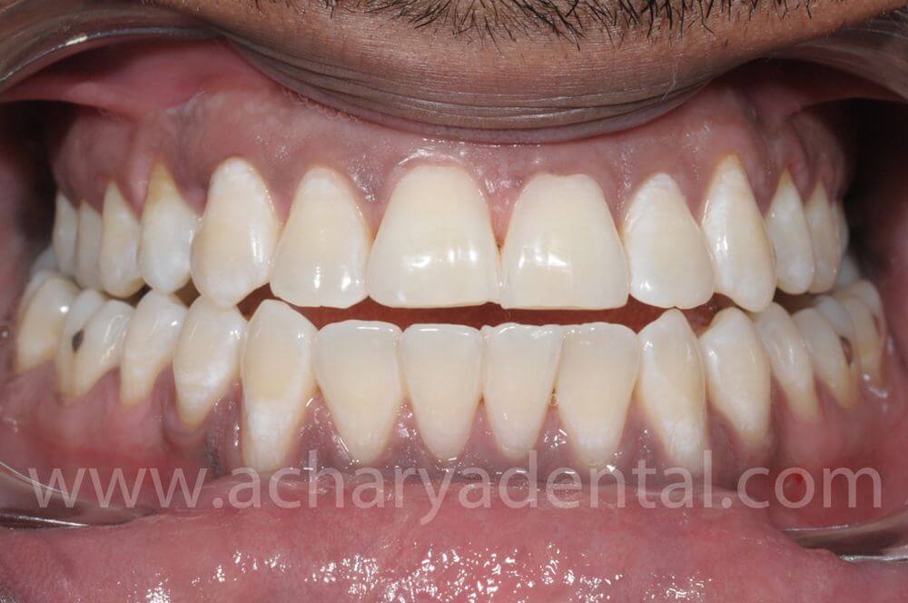 Post Whitening