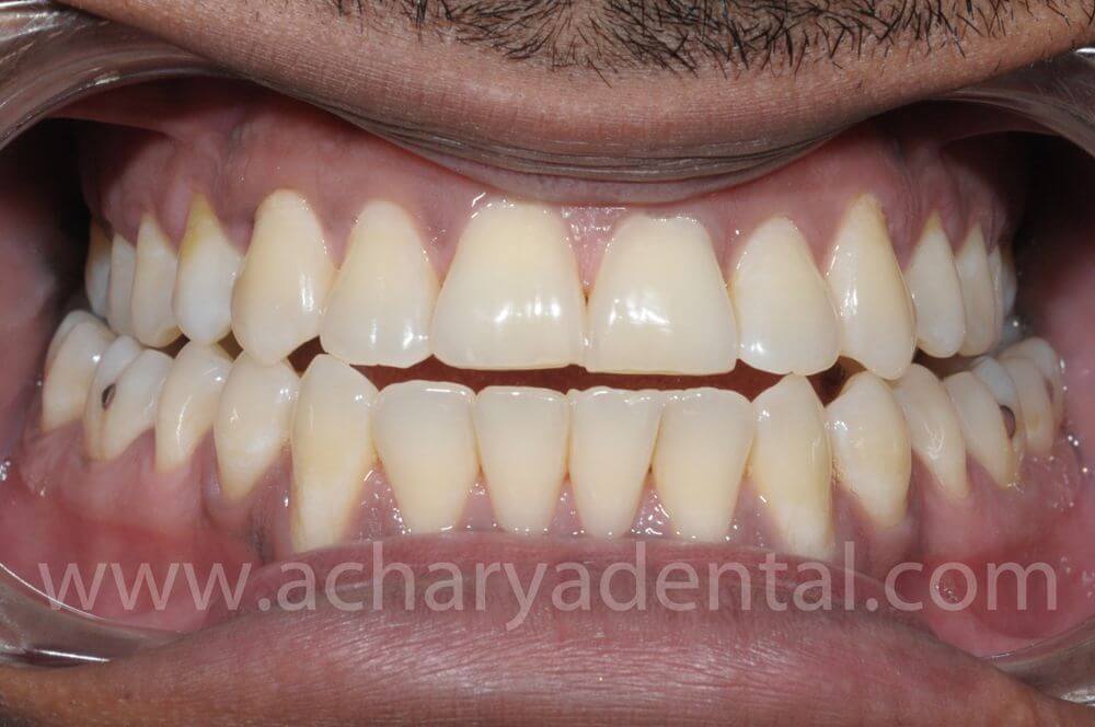 Pre Whitening