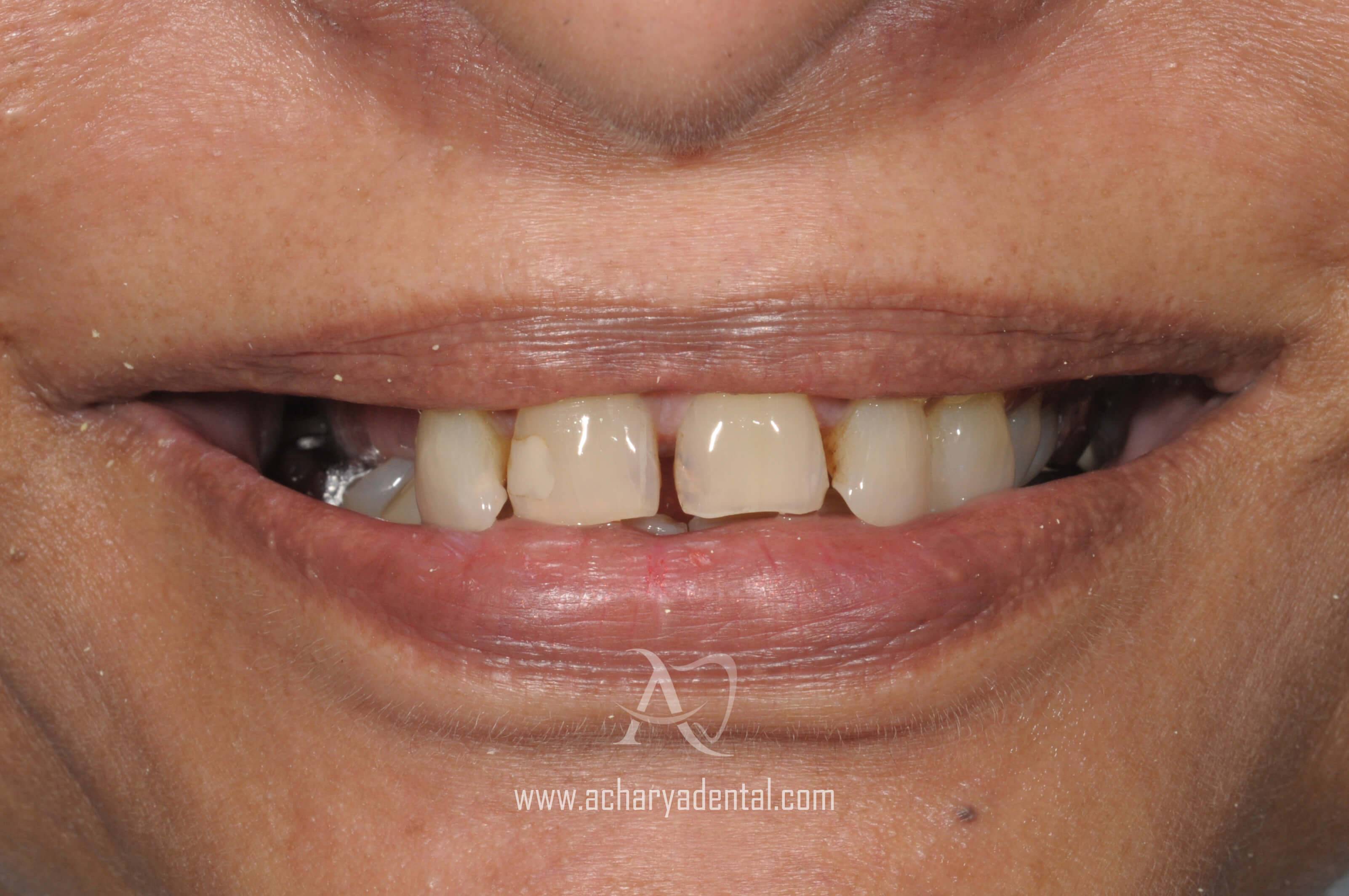 pre dental implant treatment