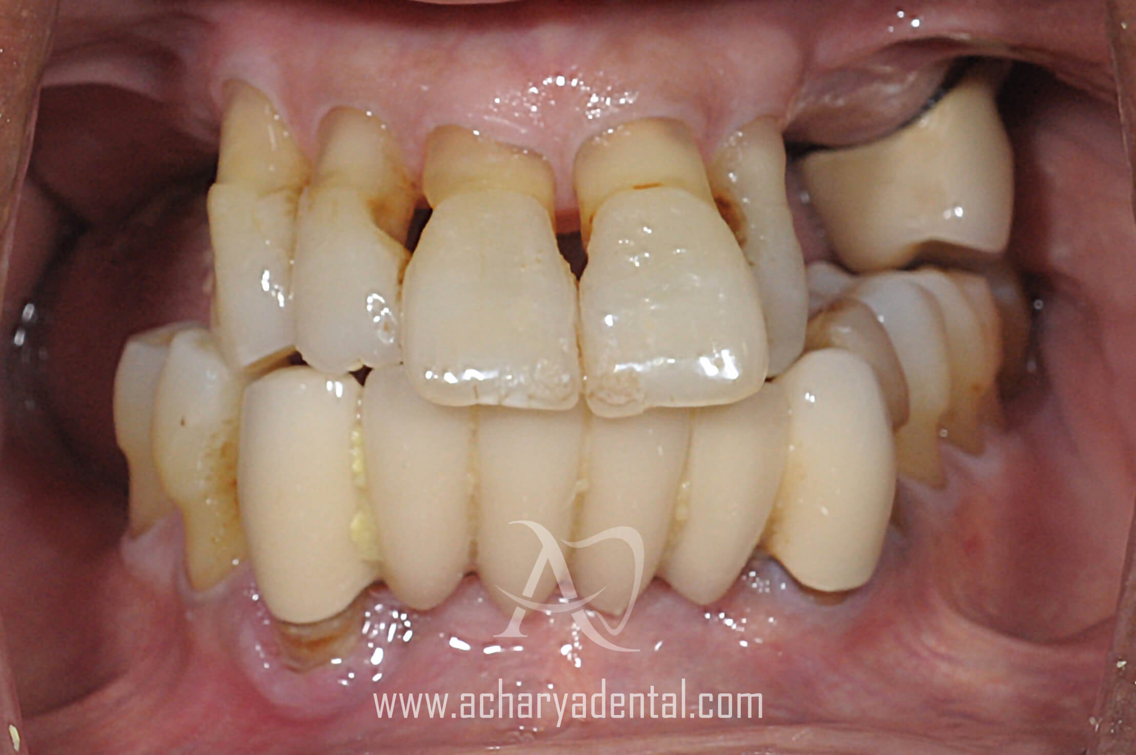 pre dental implant