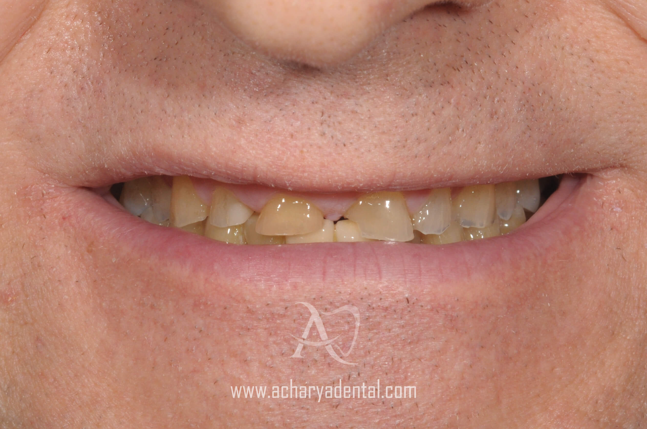 pre full mouth rehabilitation treatment