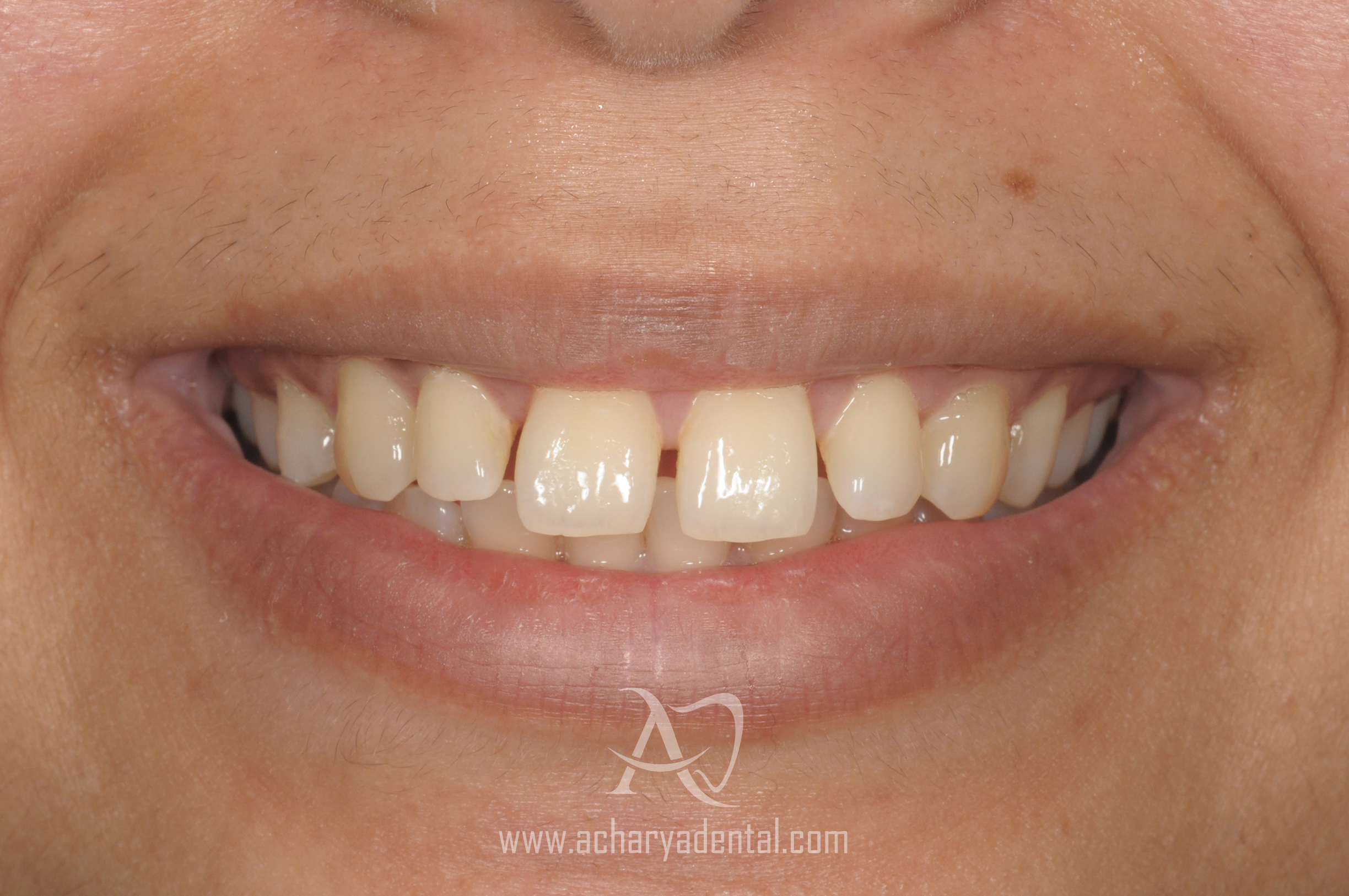 pre smile makeover treatment