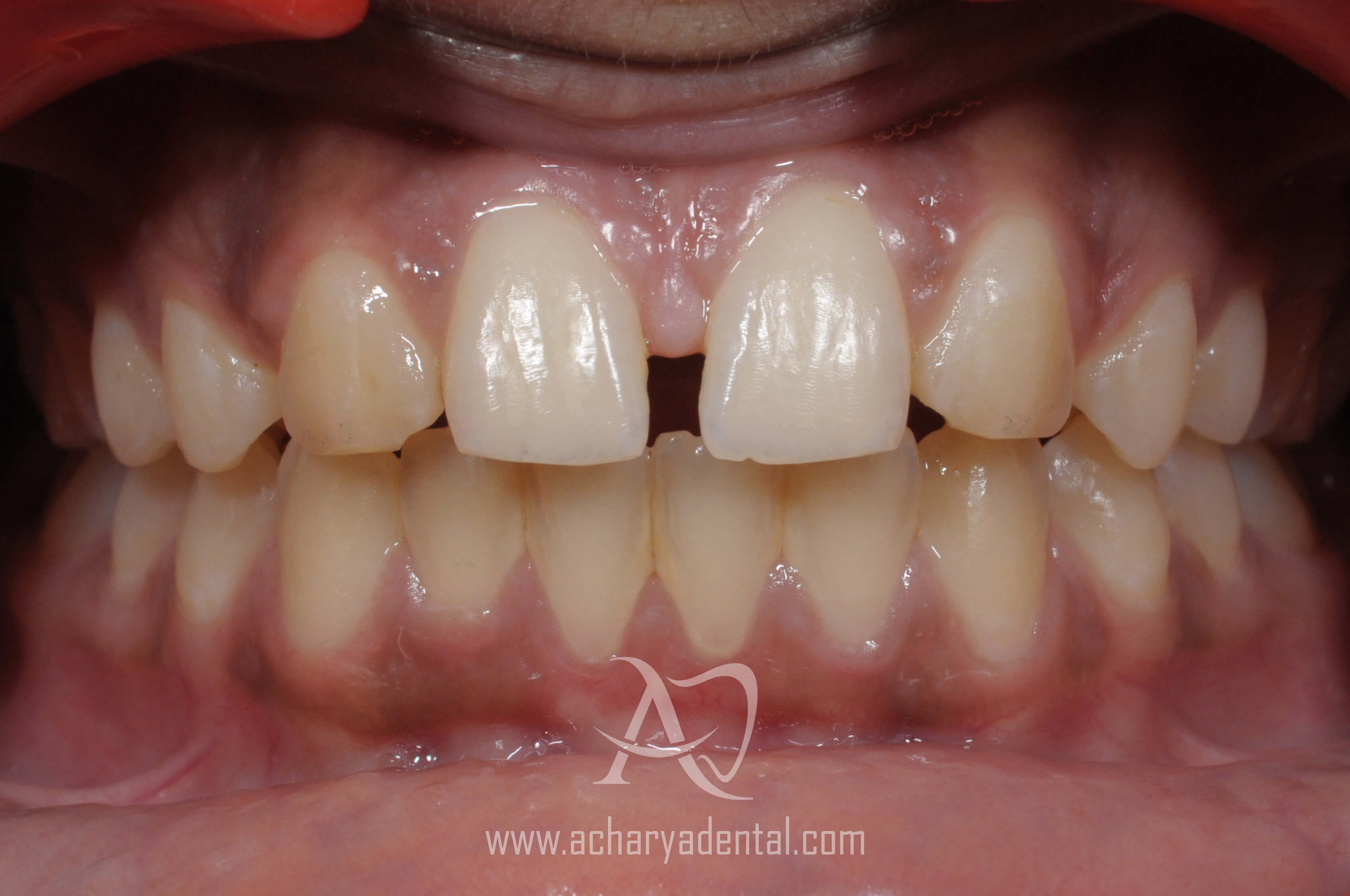 before orthodontics treatment