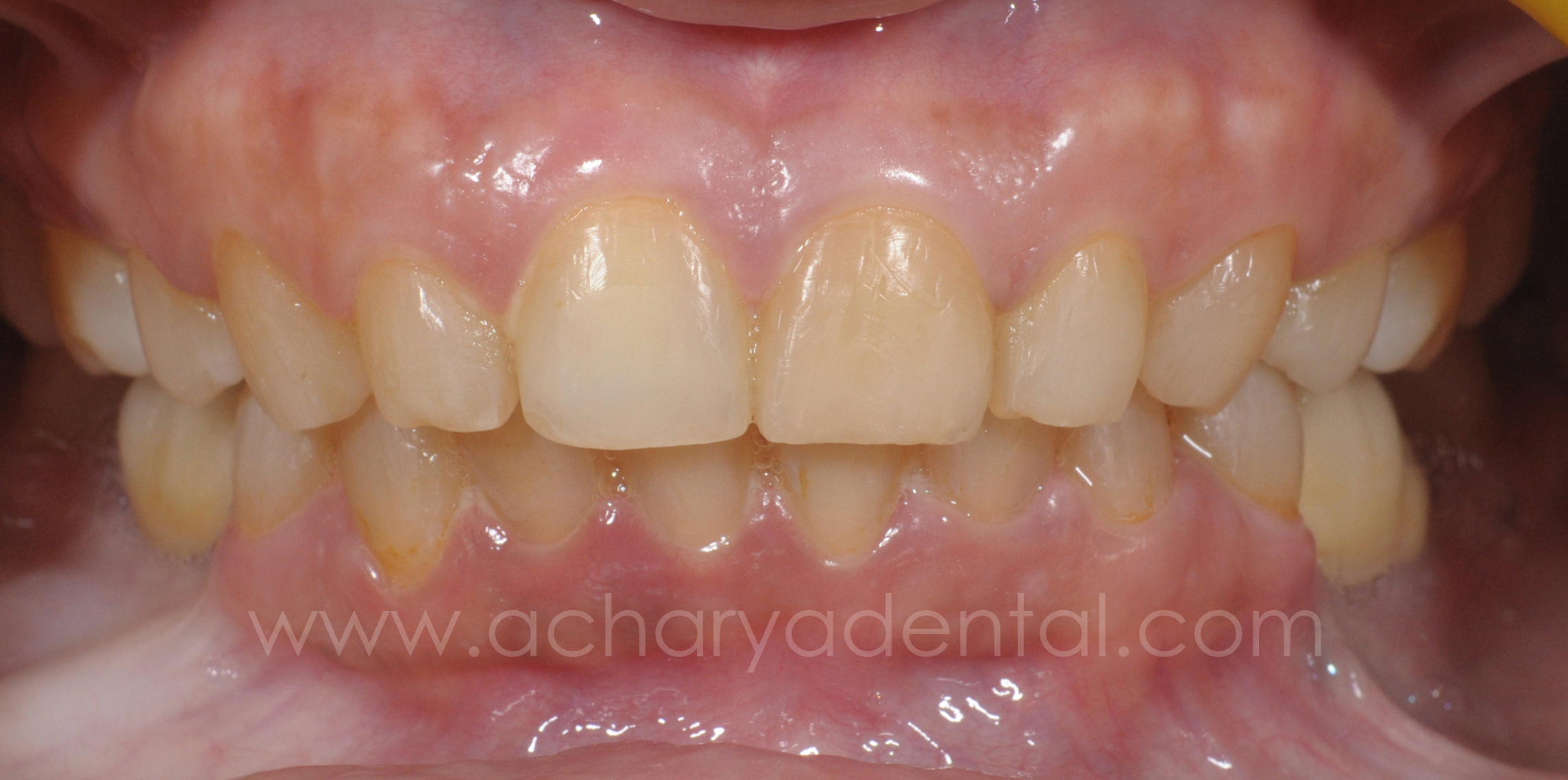 after full mouth rehabilitation