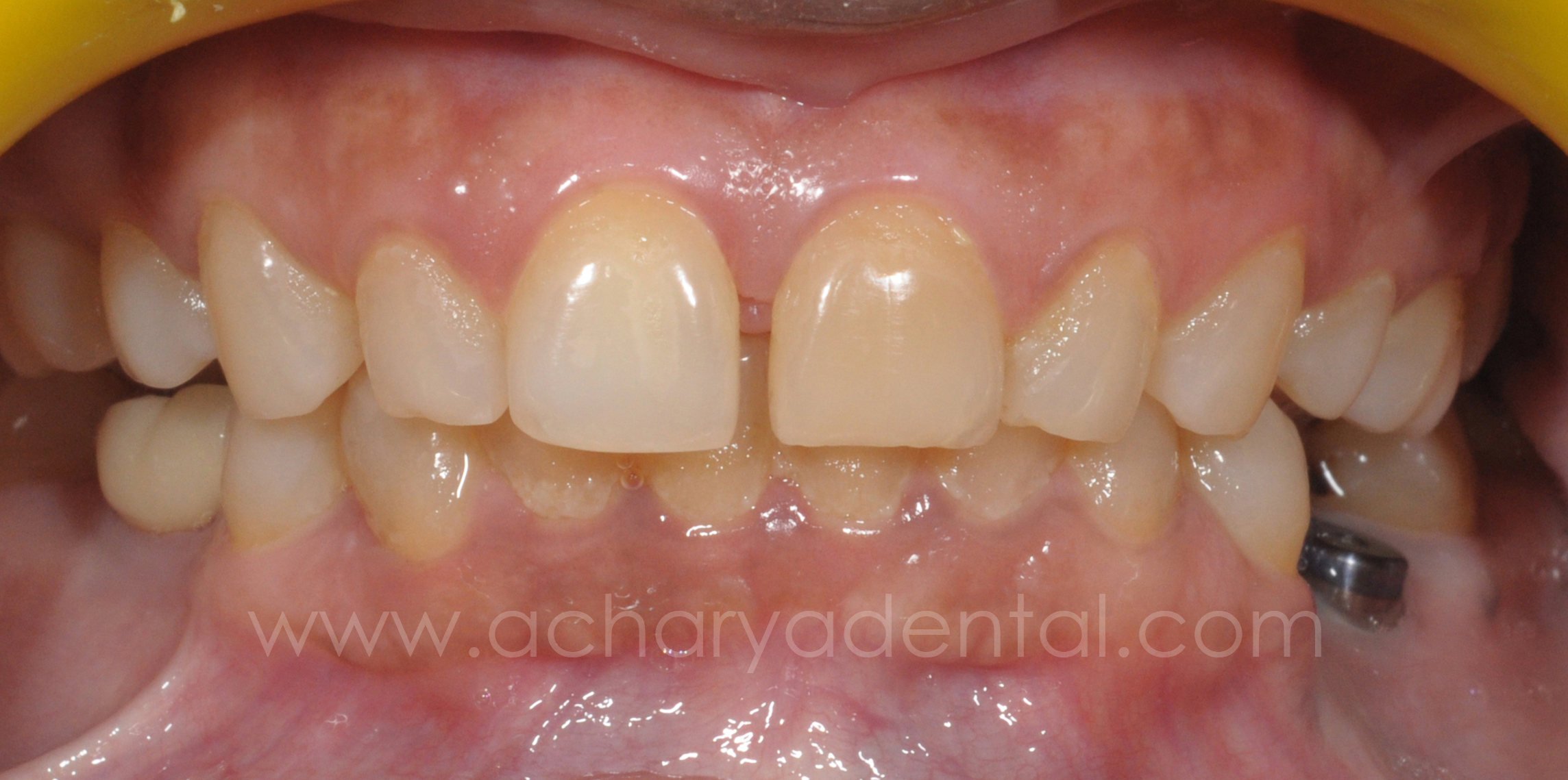 before full mouth rehabilitation