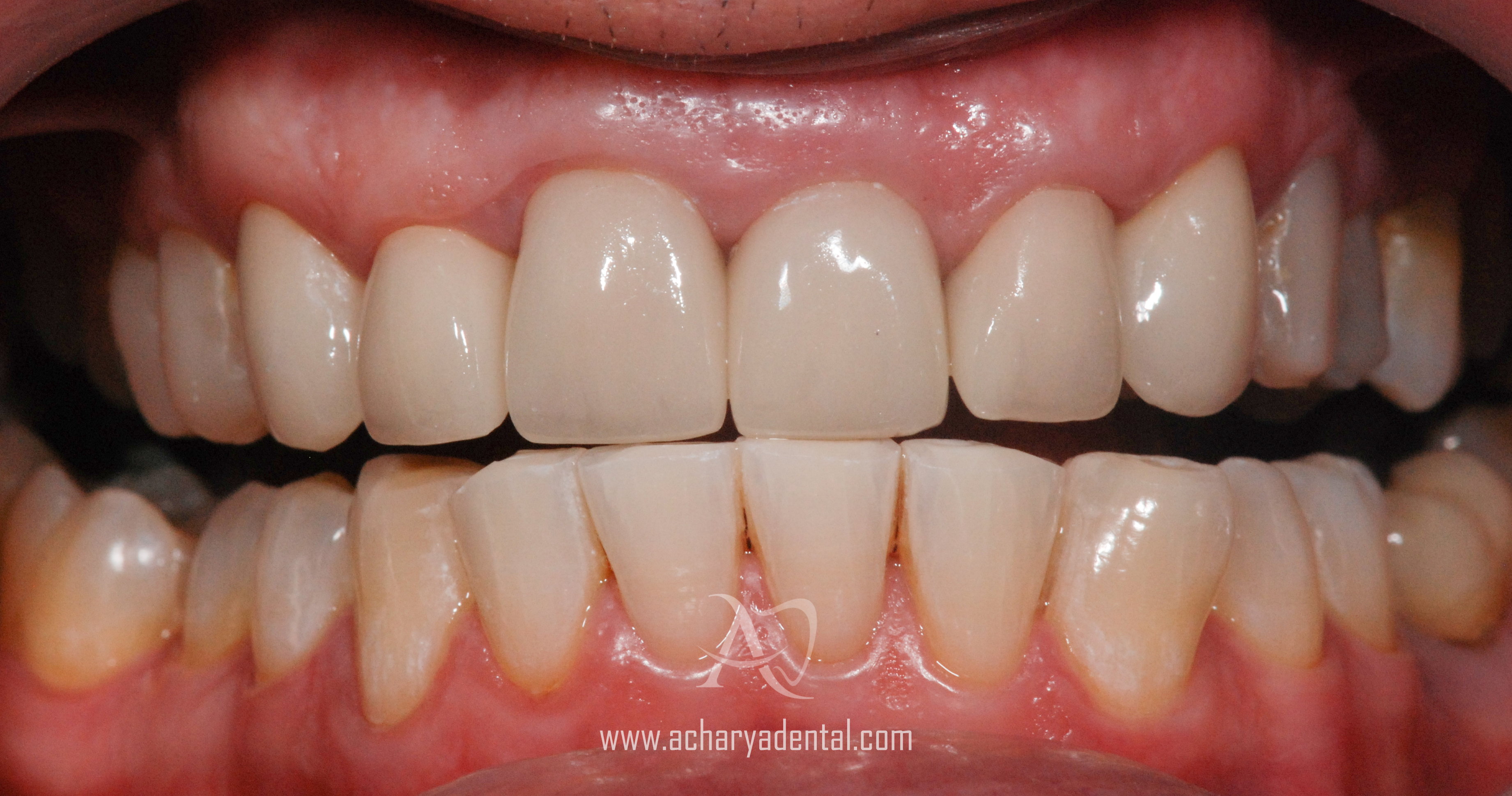 after smile makeover