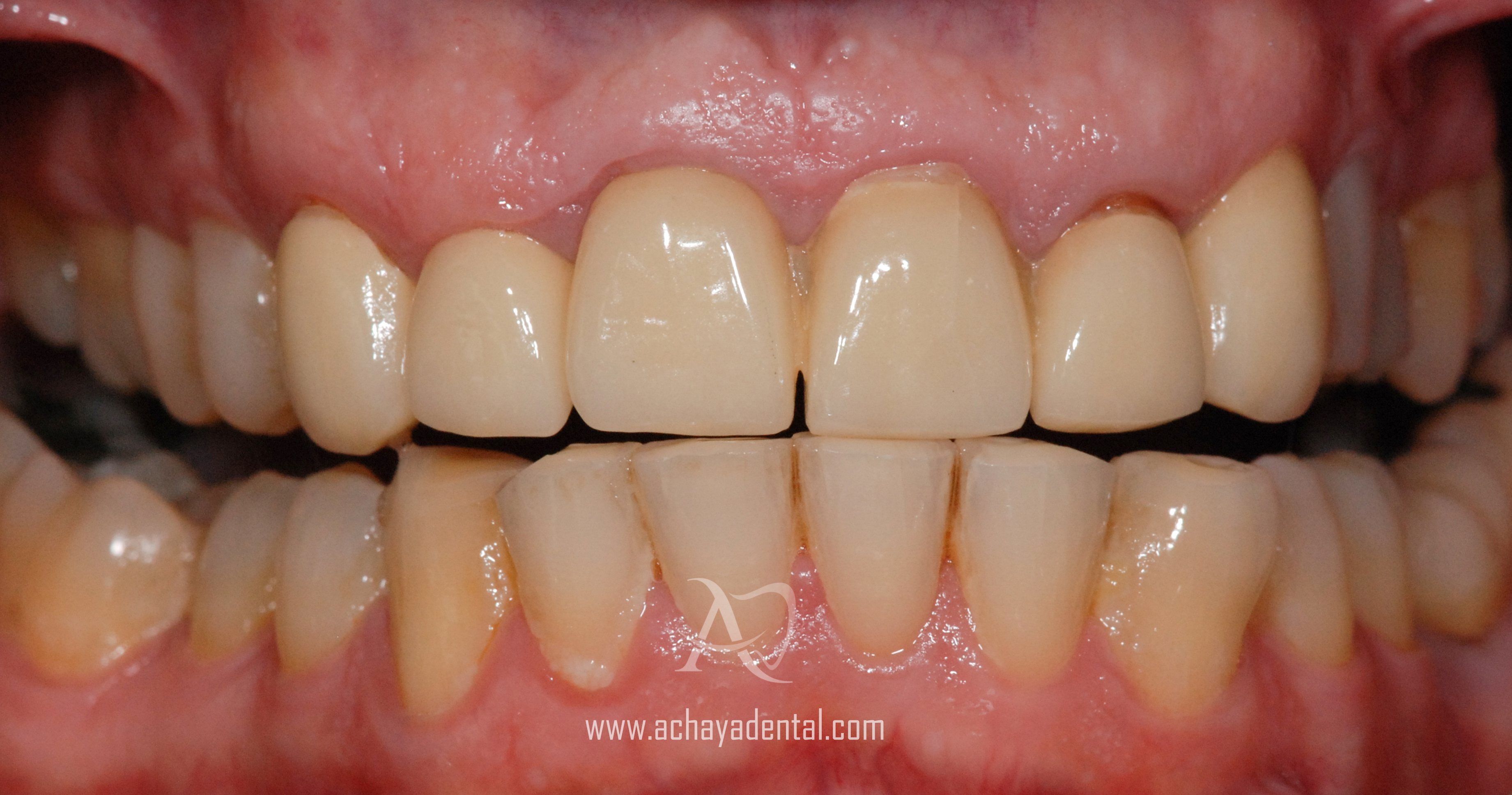 before smile makeover