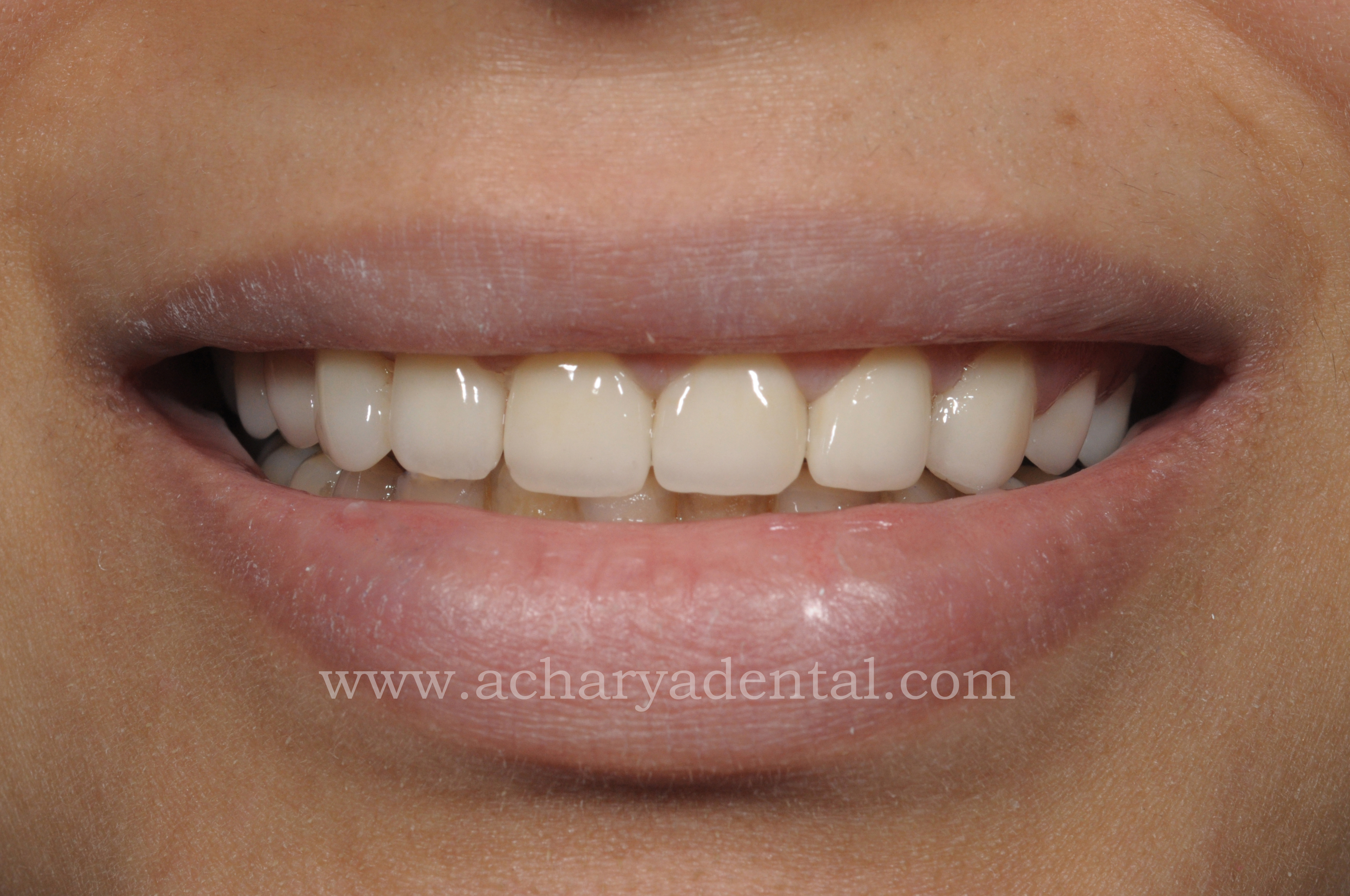 post smile makeover treatment