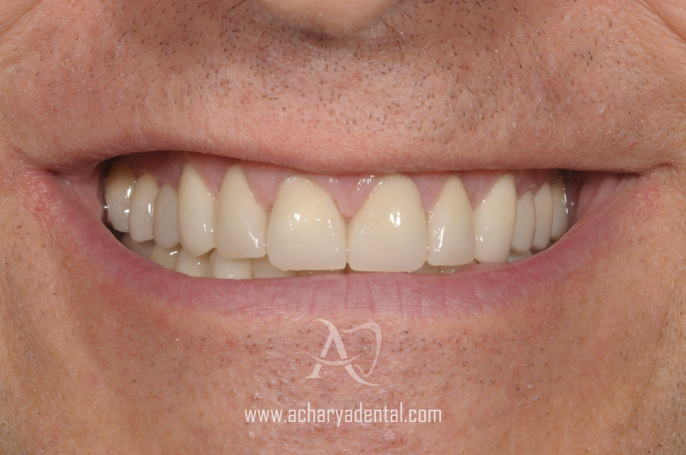 post smile makeover