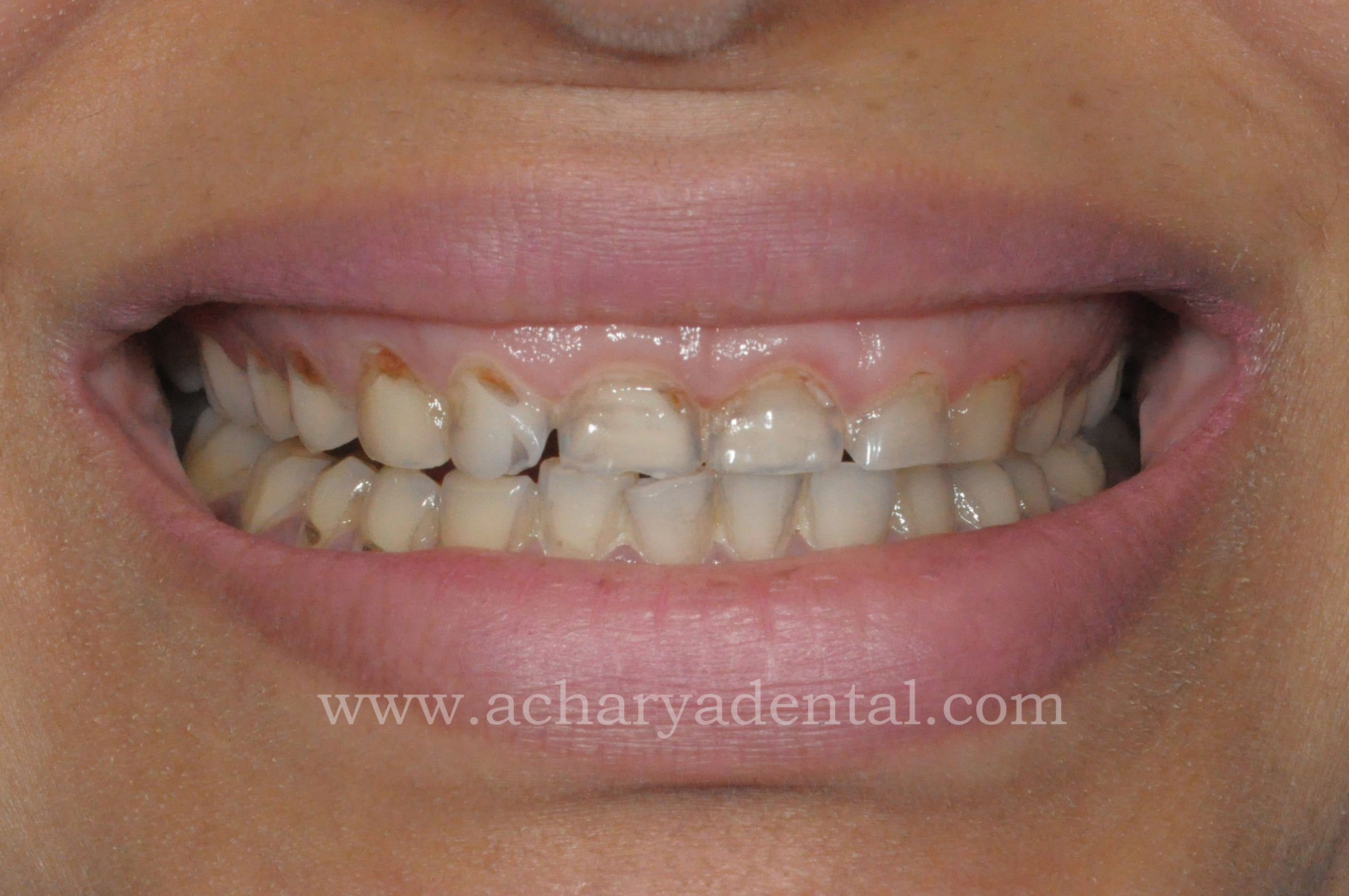 pre smile makeover treatment