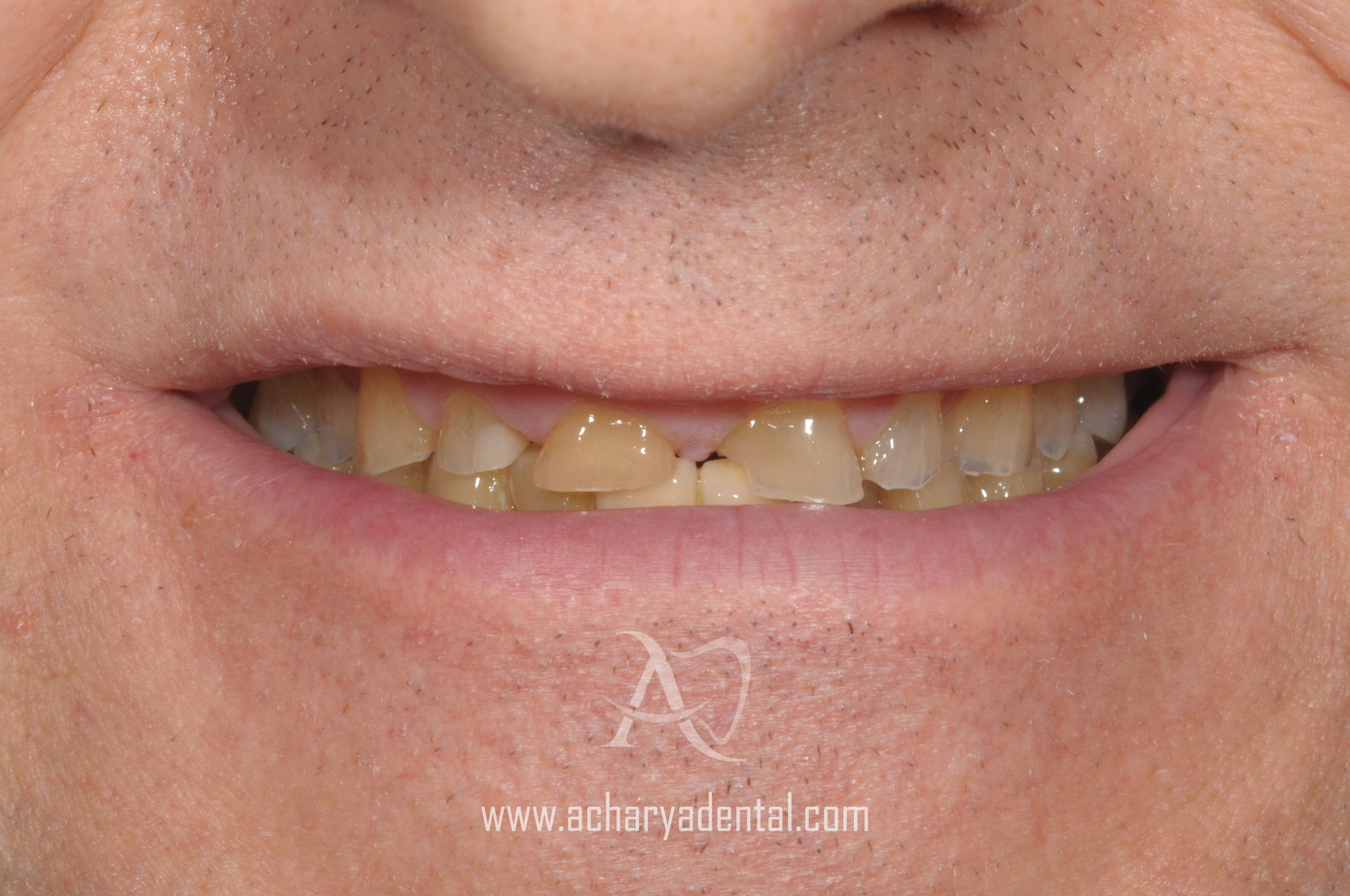 pre smile makeover