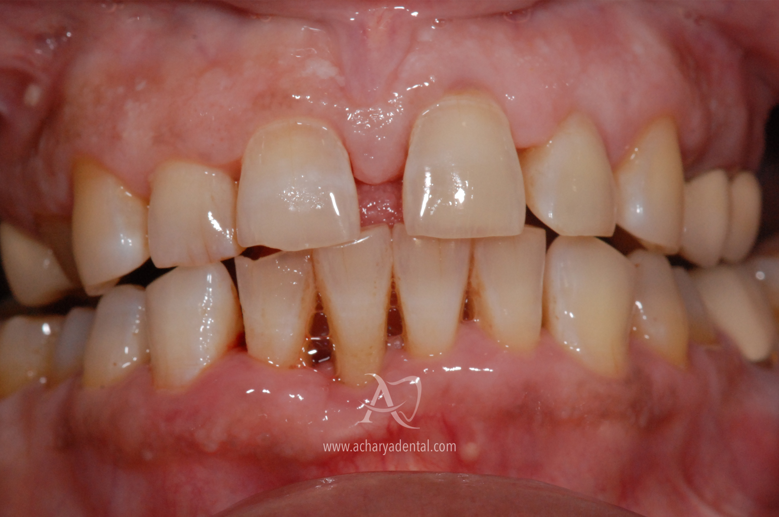 After image