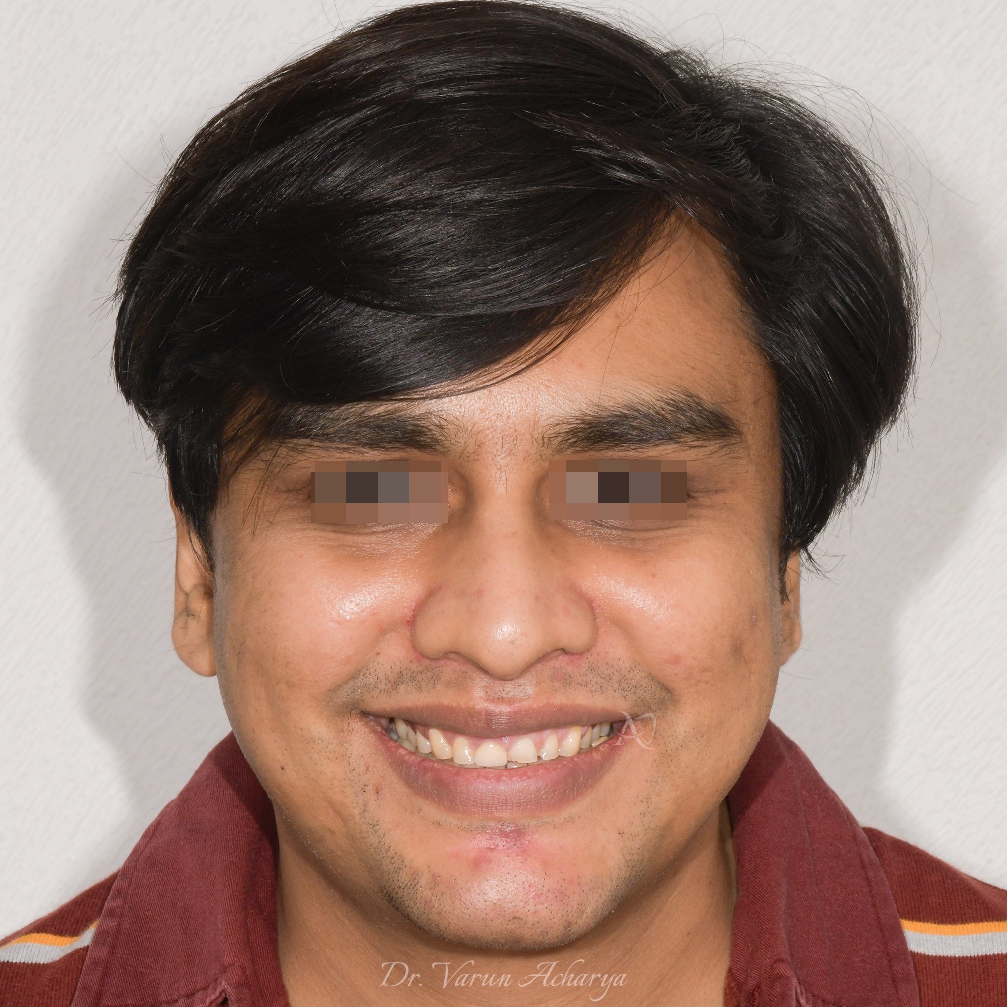 before smile makeover
