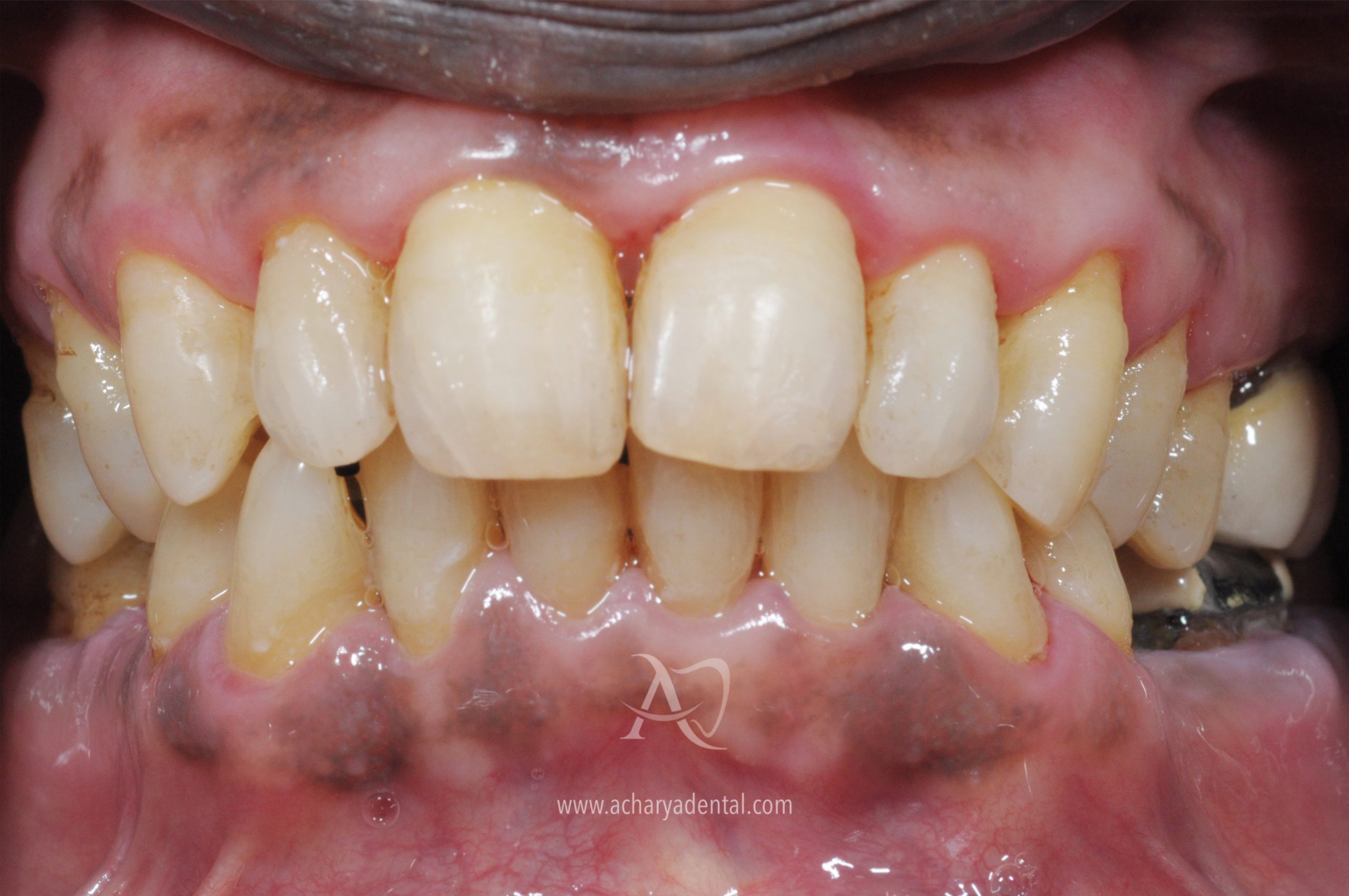 teeth cleaning