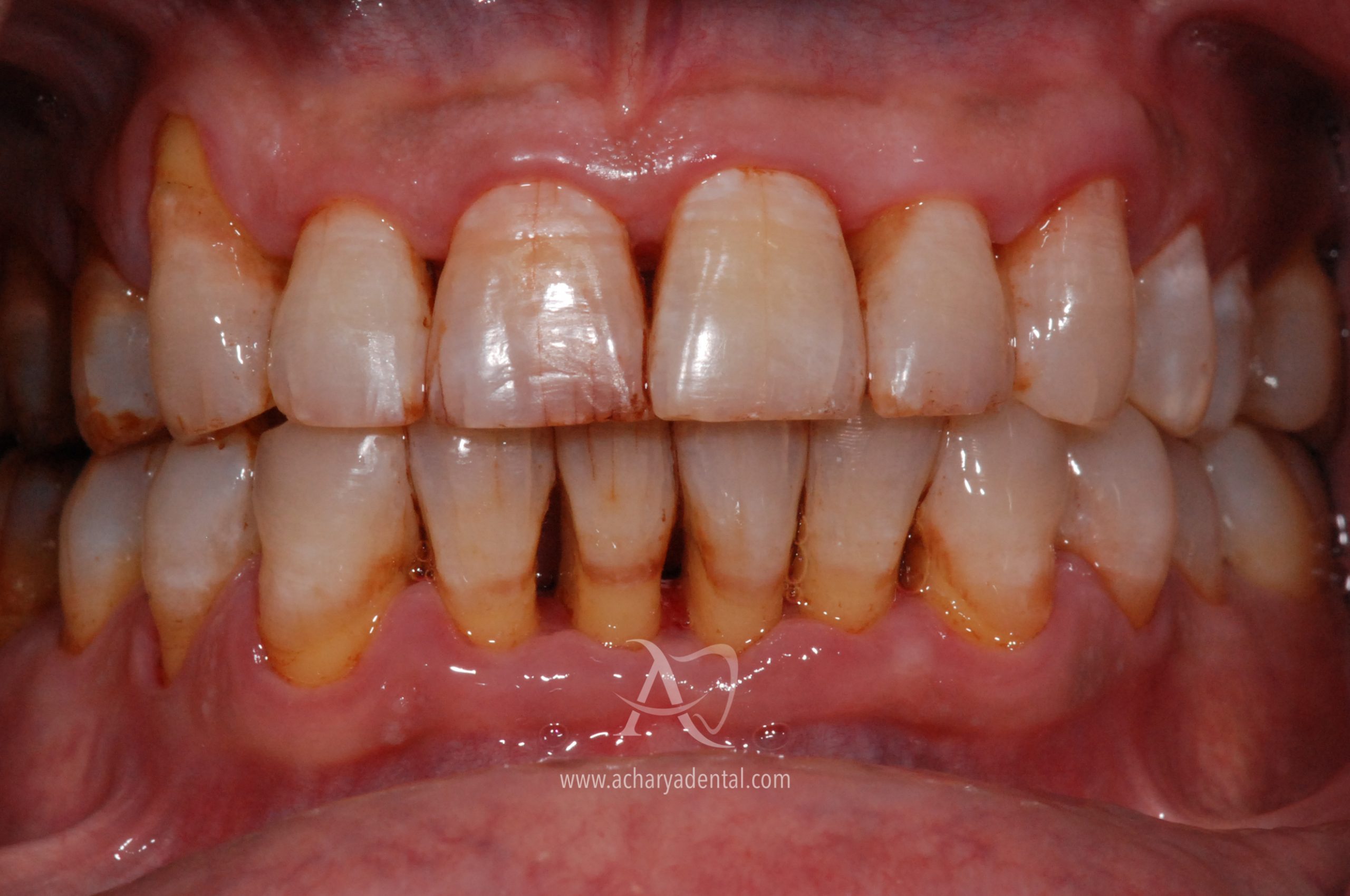Teeth cleaning