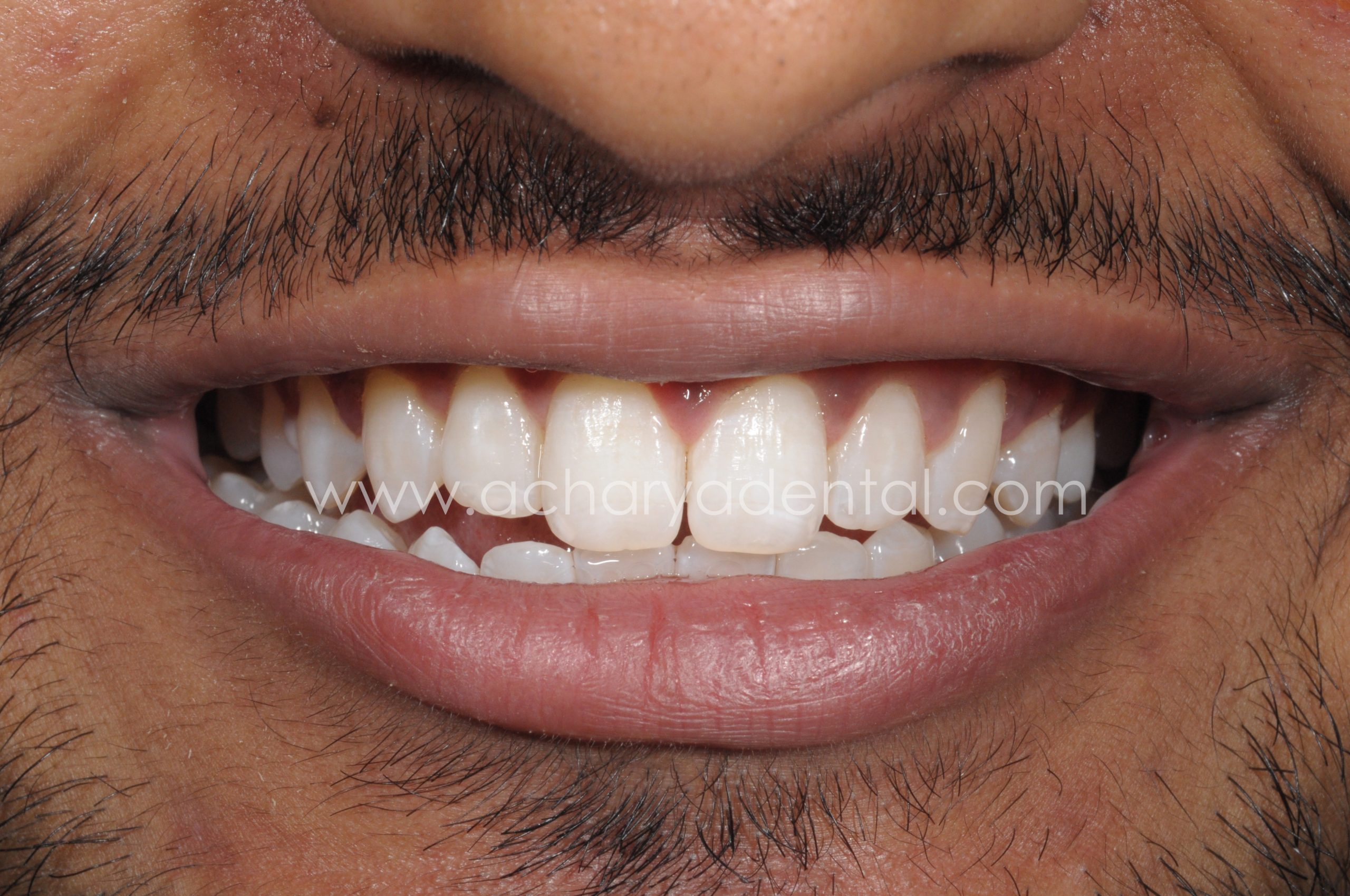 teeth whitening
