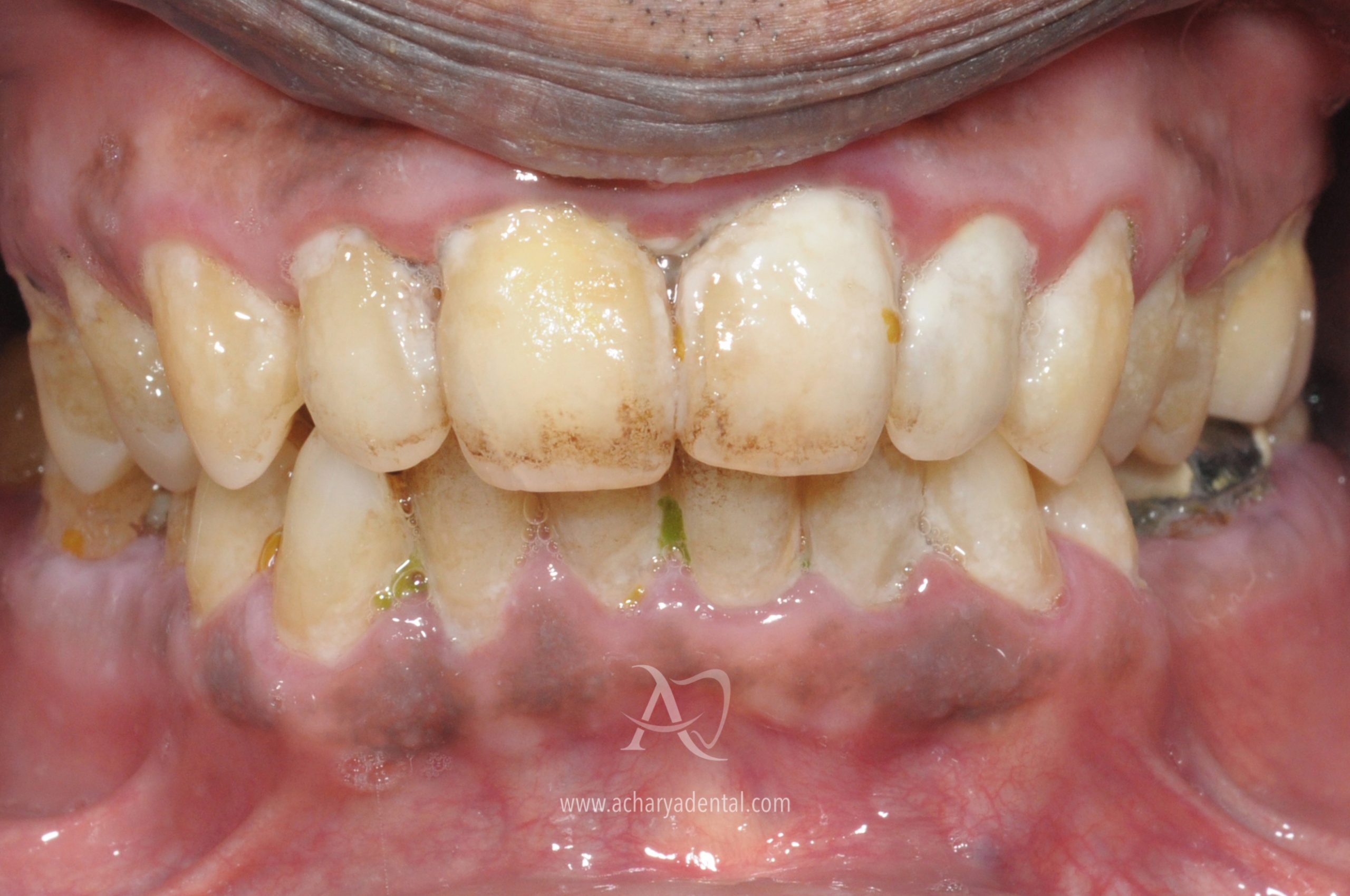 teeth cleaning