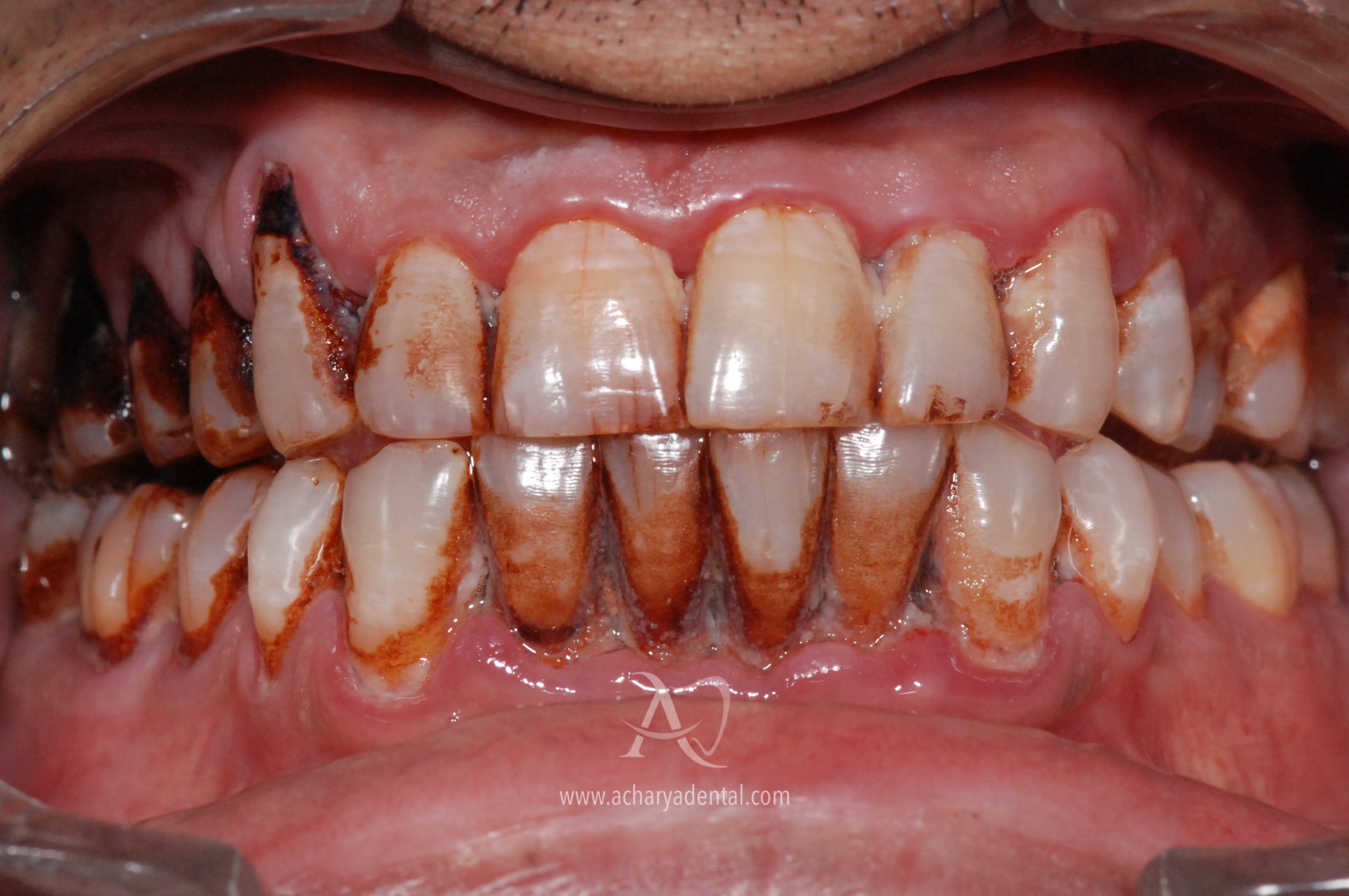 teeth cleaning