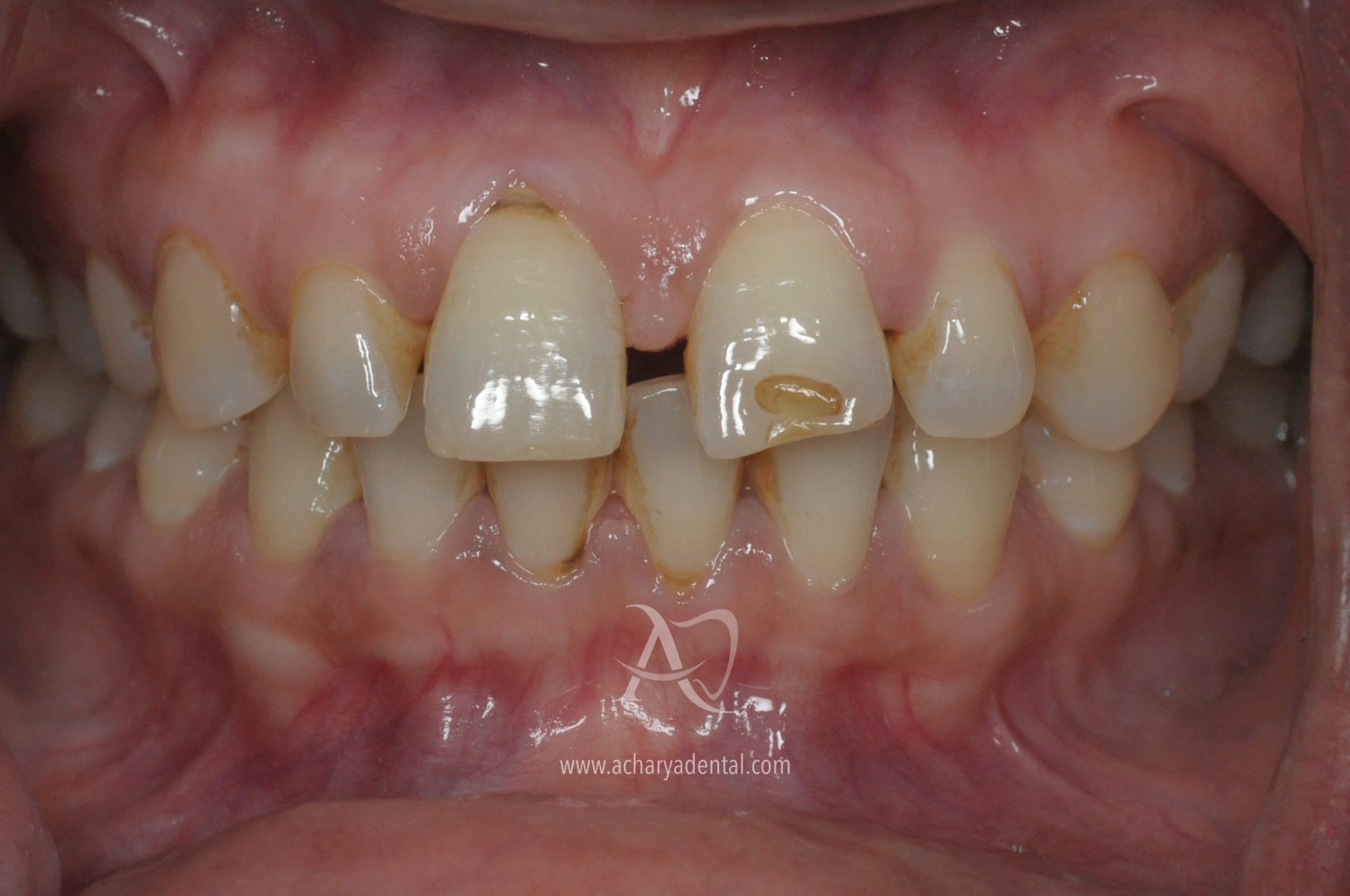 teeth cleaning