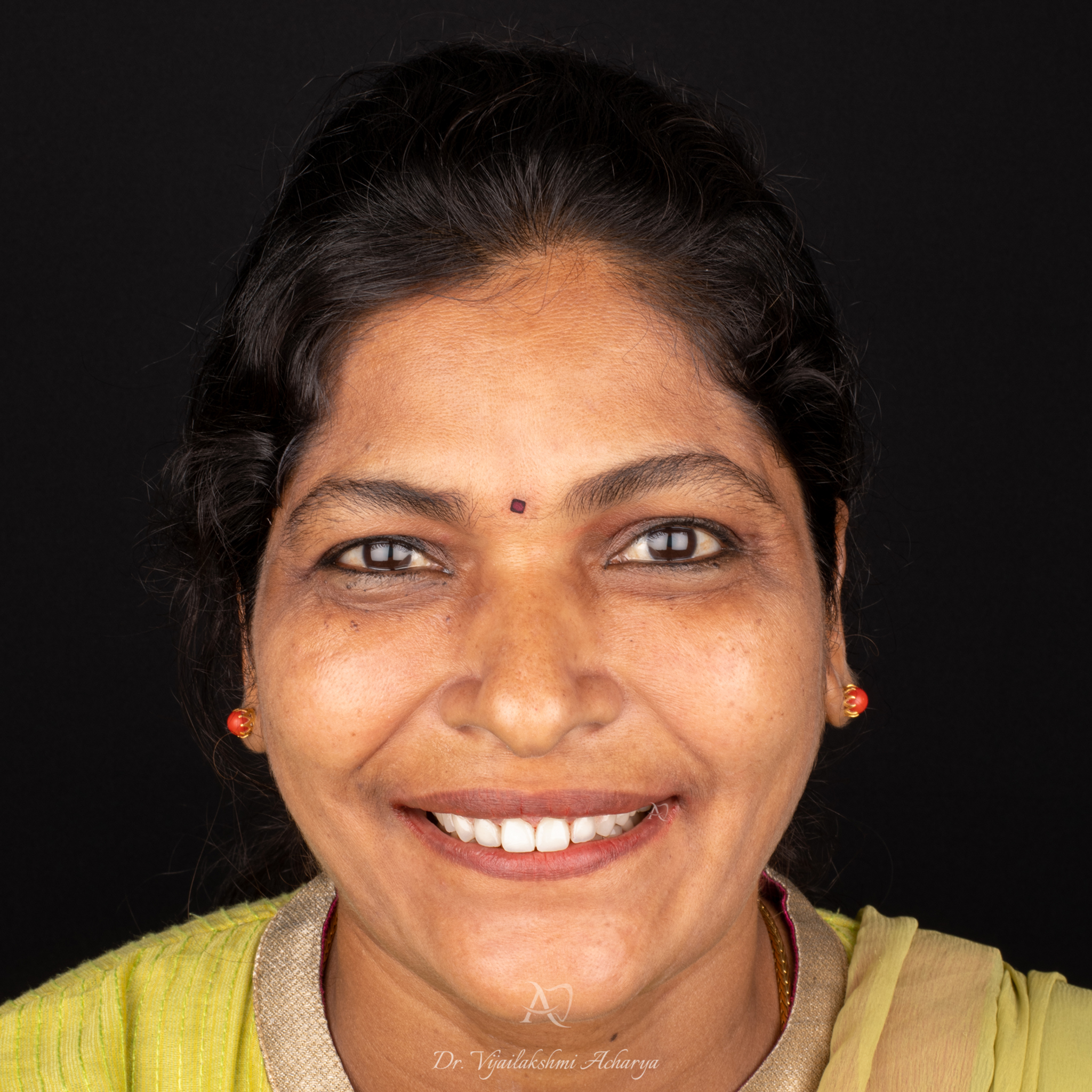 after smile makeover