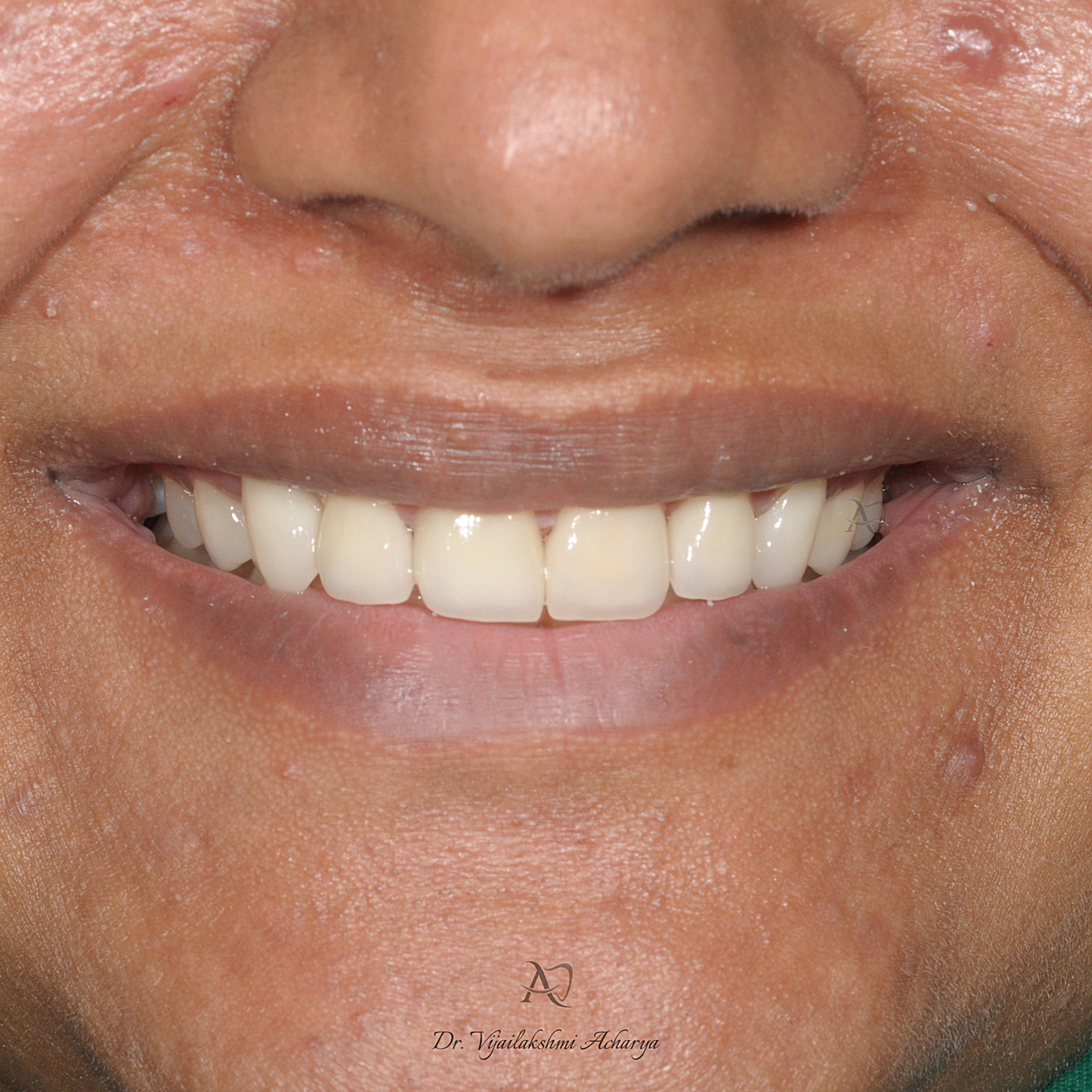 after smile makeover