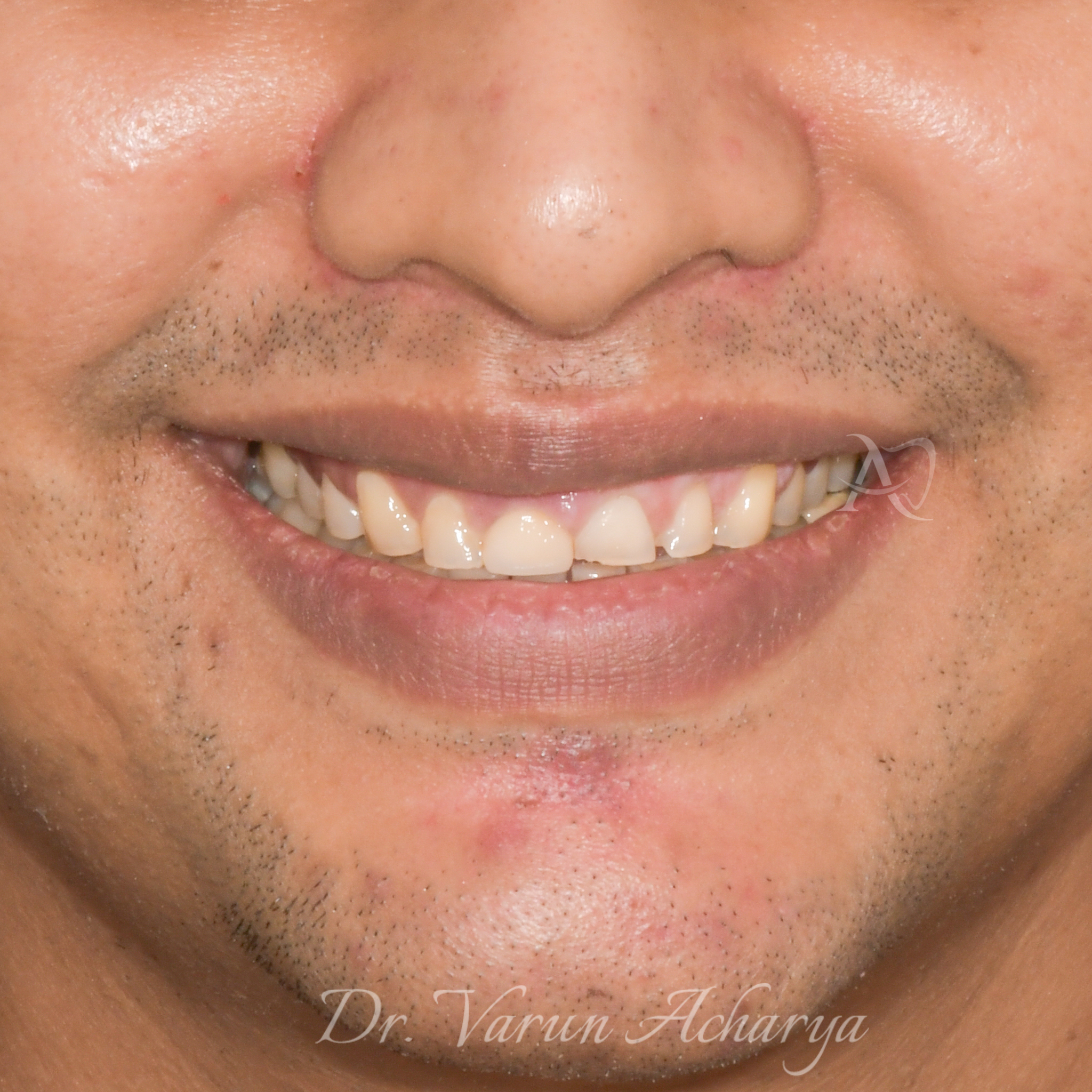 full mouth rehabilitation