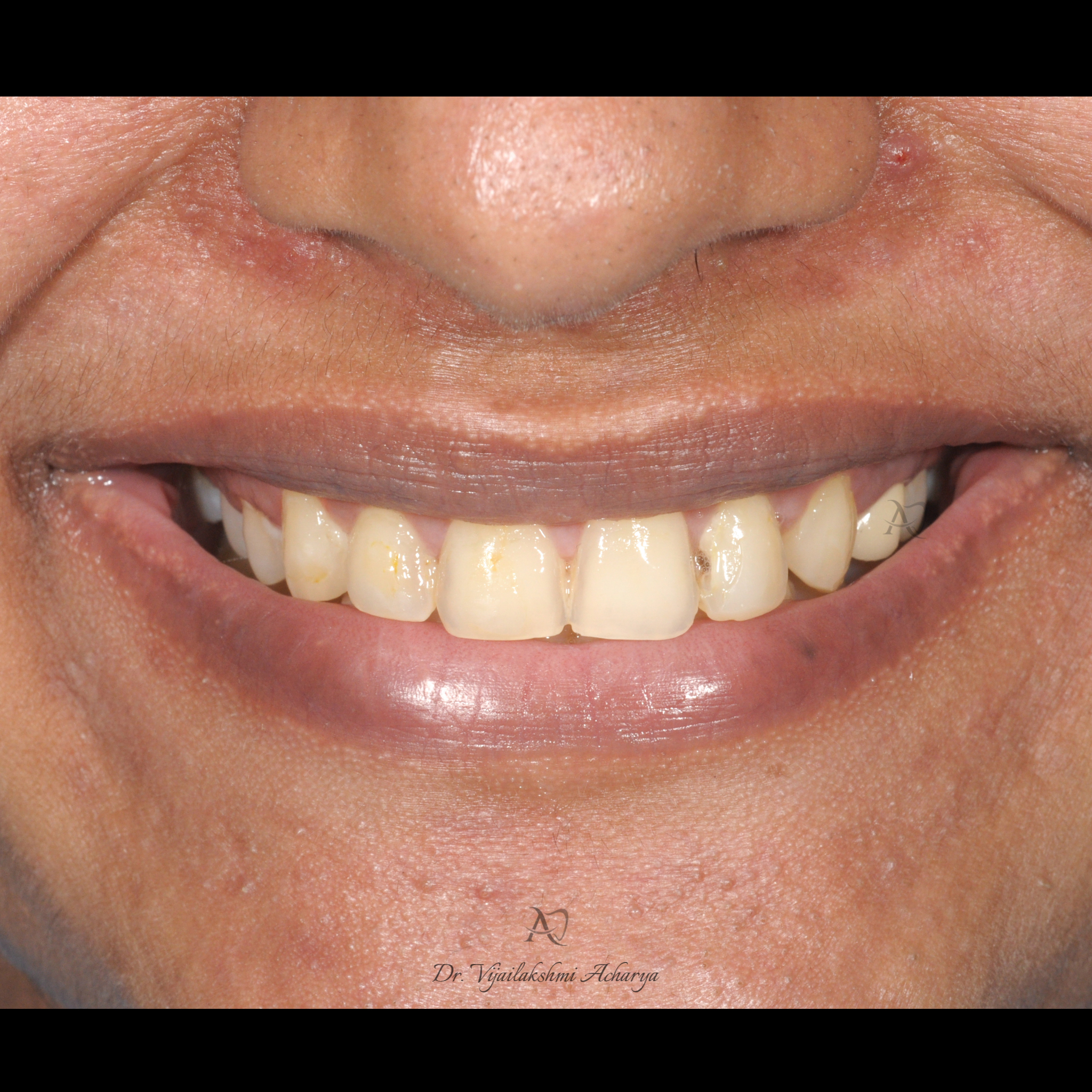 before smile makeover