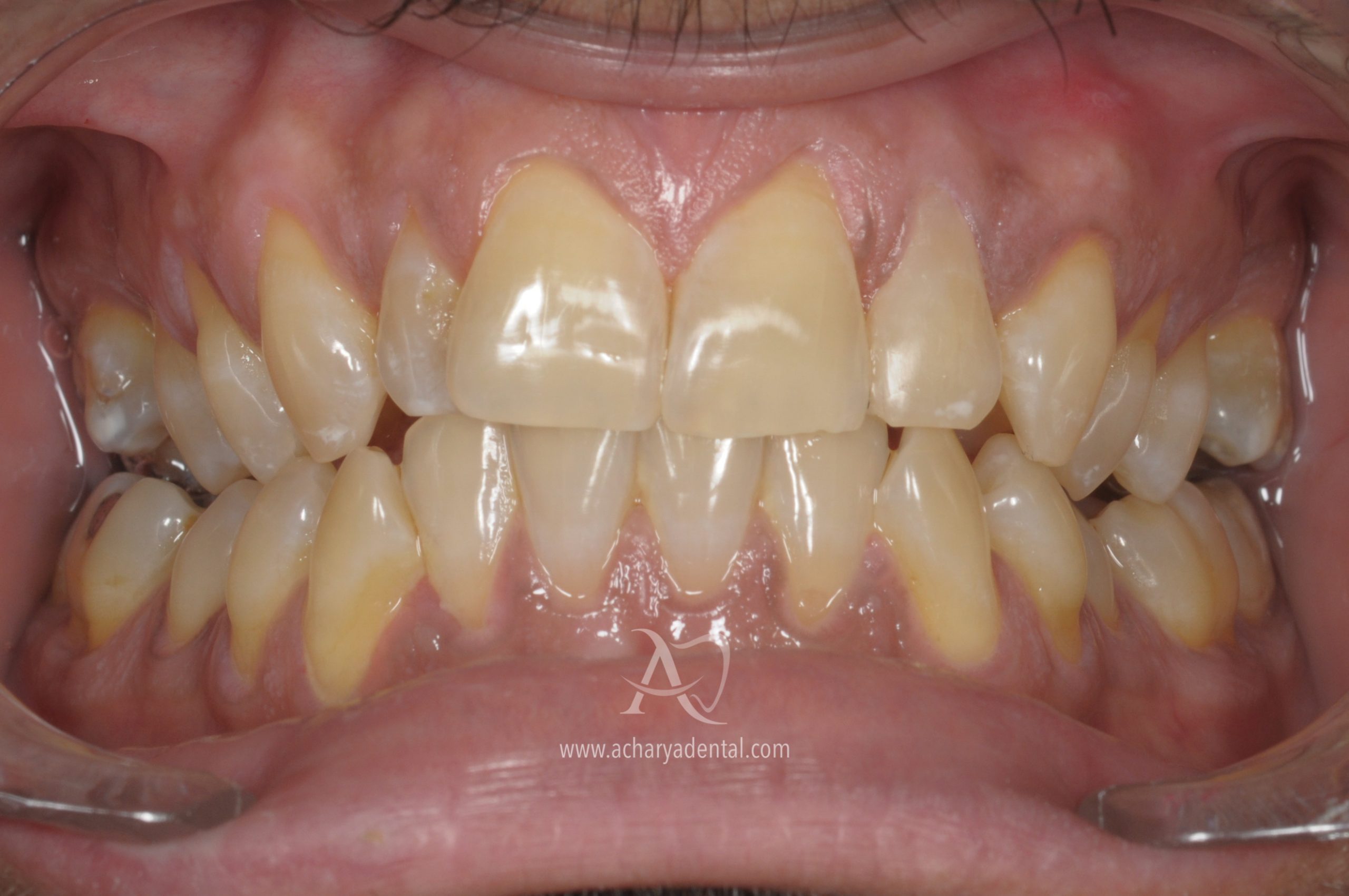 after fillings