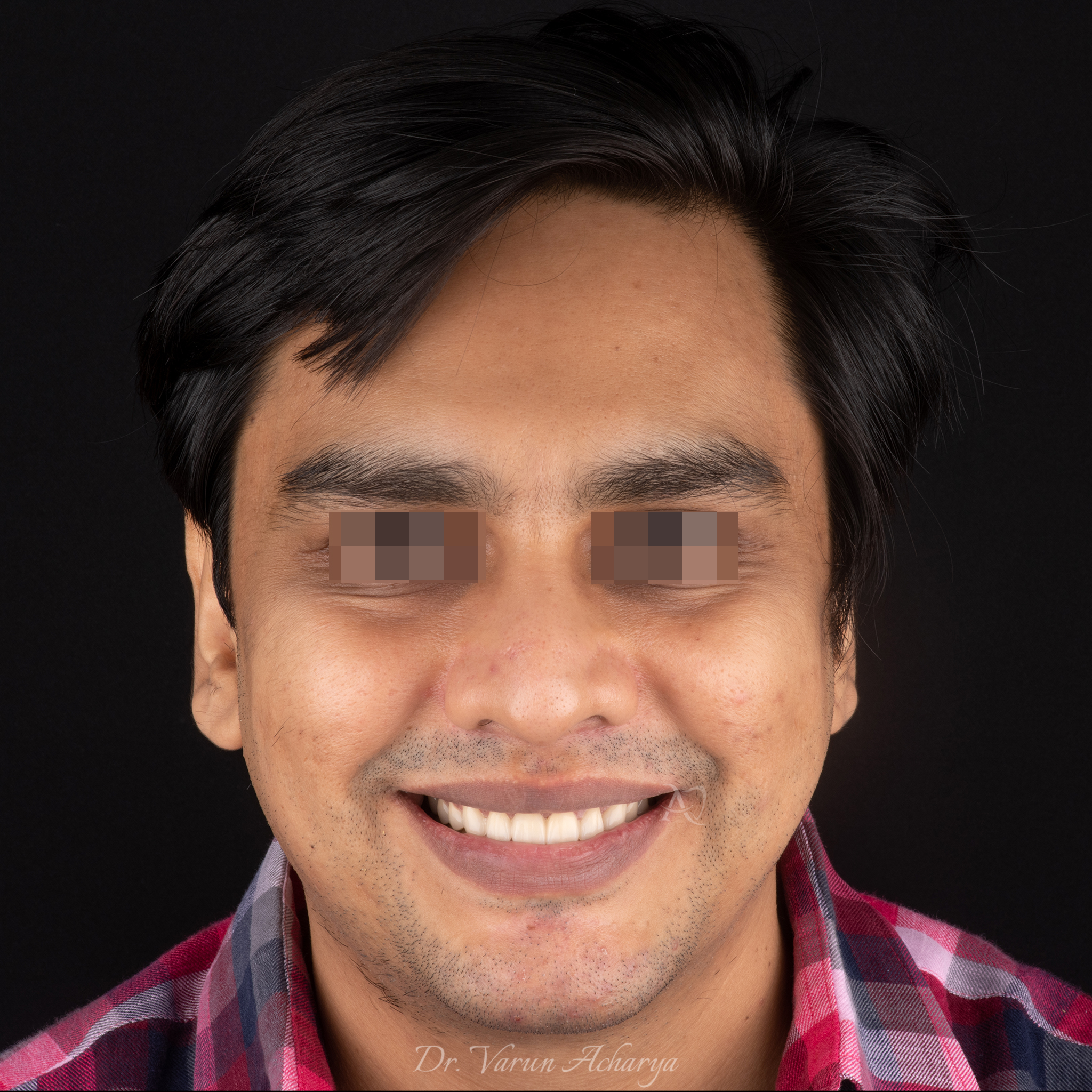 after smile makeover