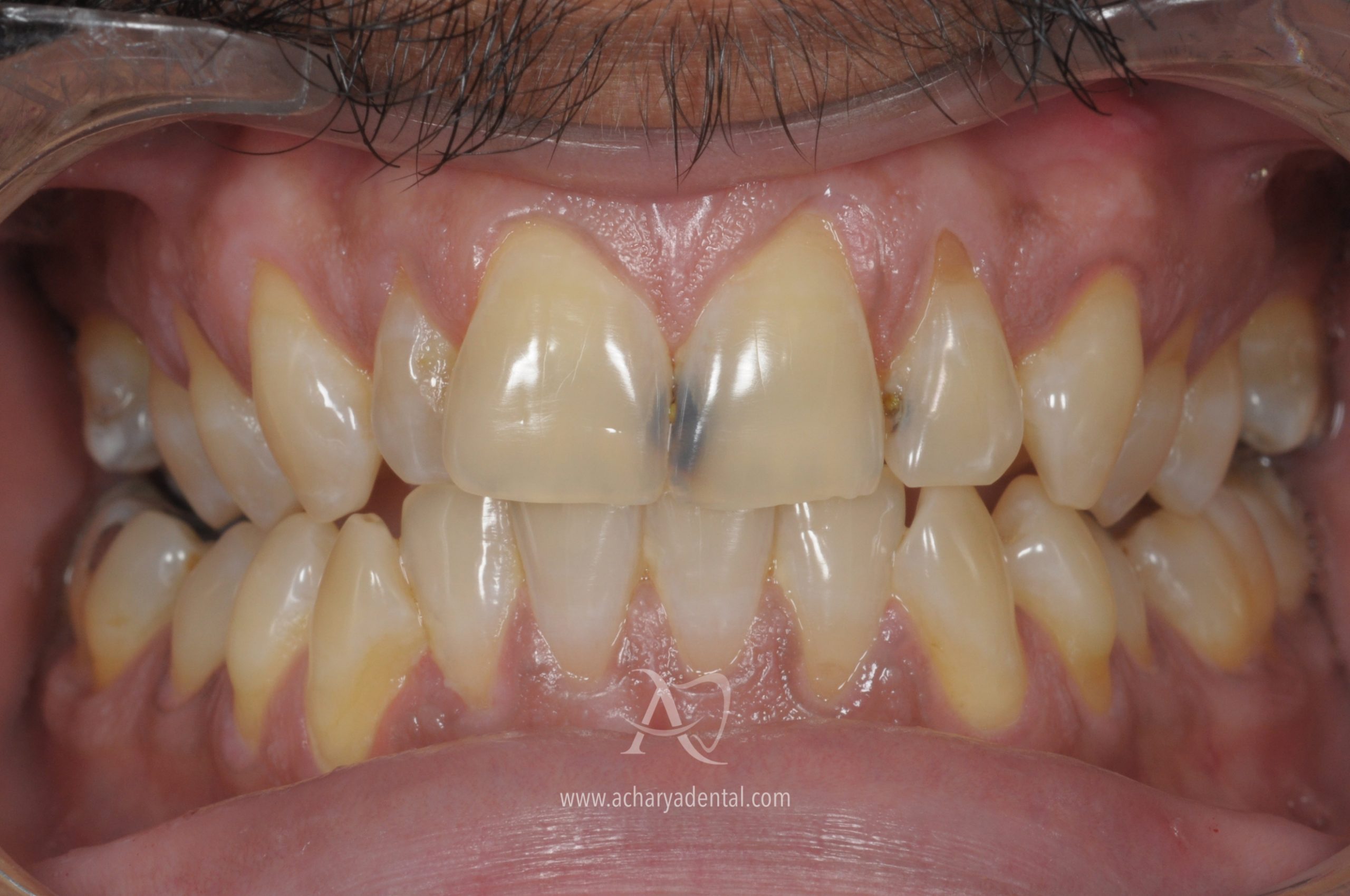 before fillings