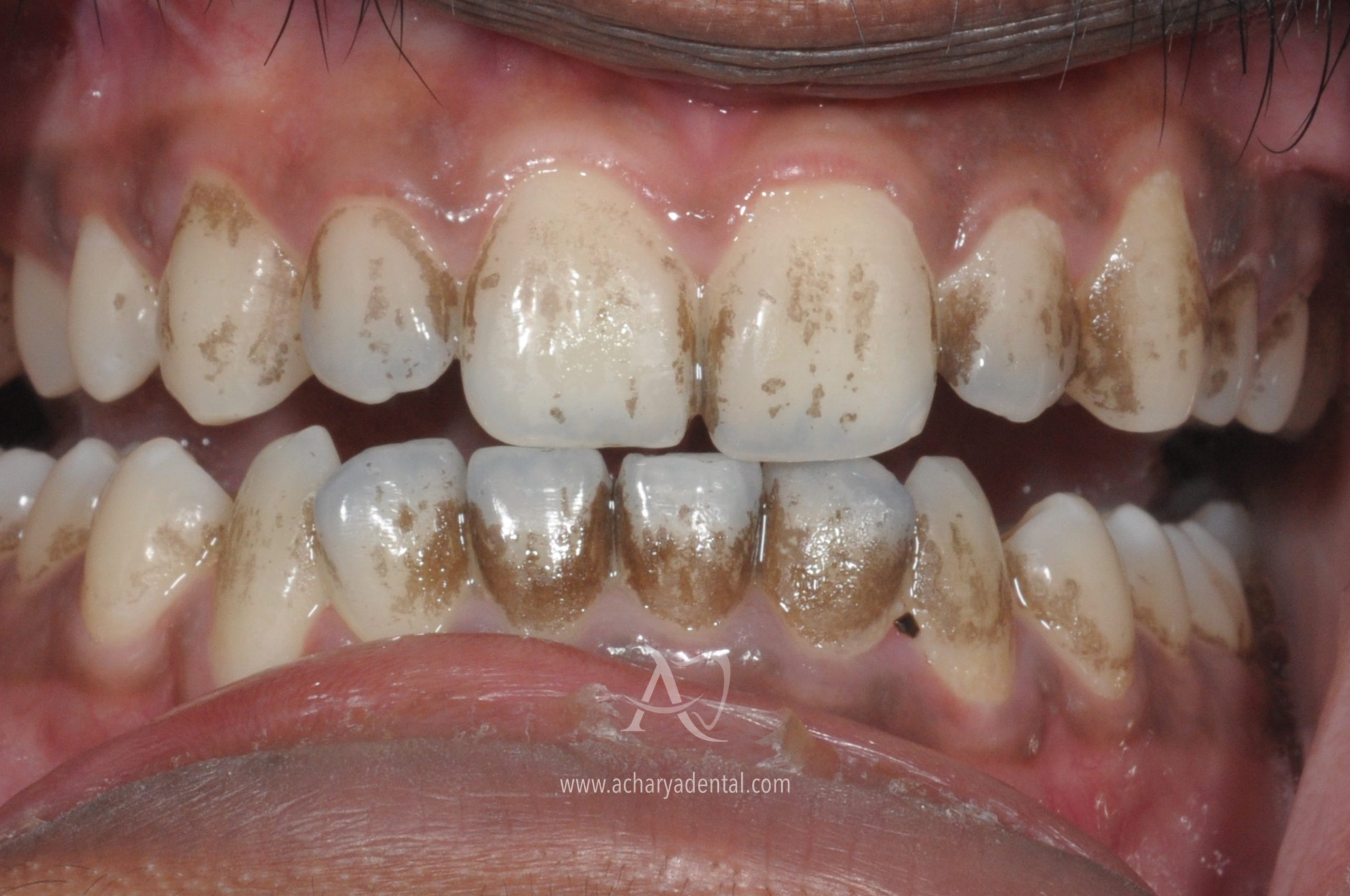 teeth cleaning