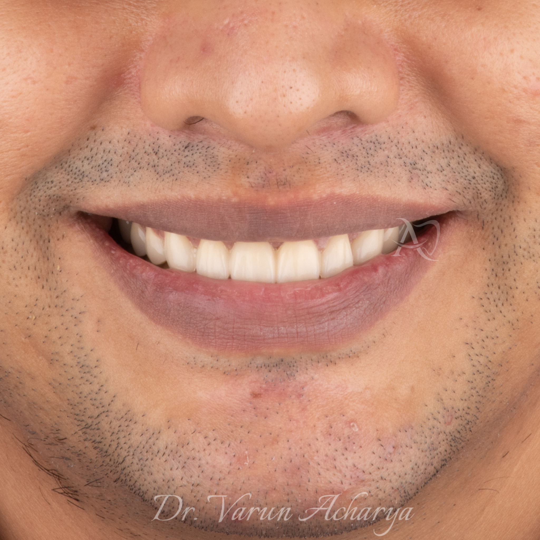 full mouth rehabilitation