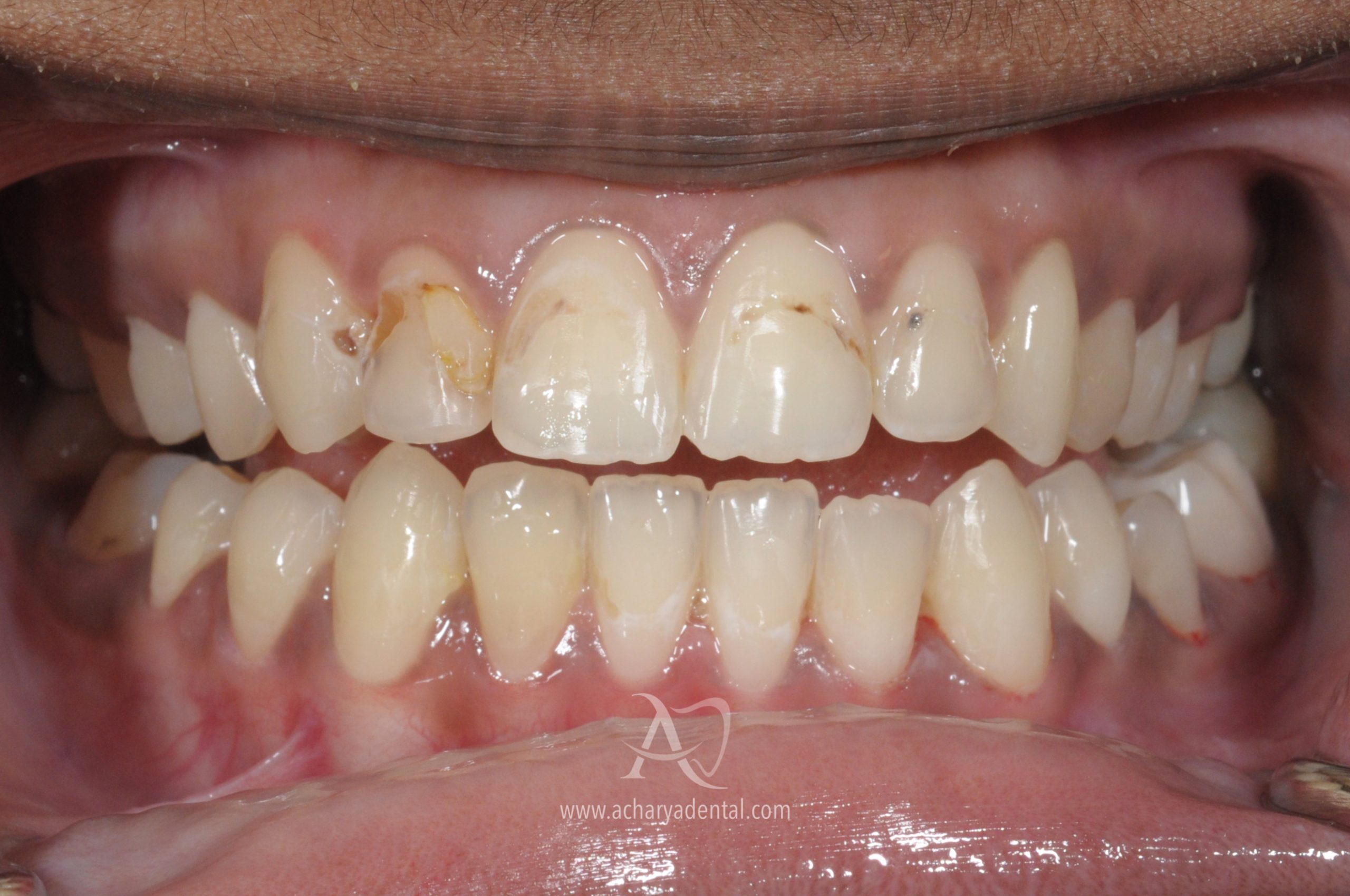pre fillings