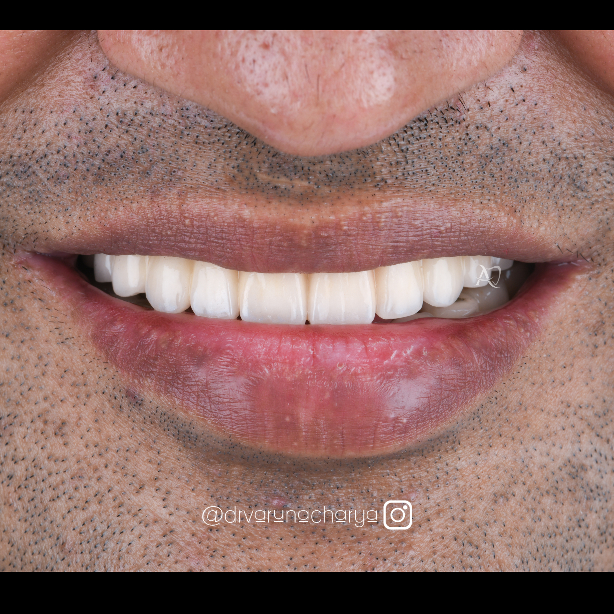 after full mouth rehabilitation