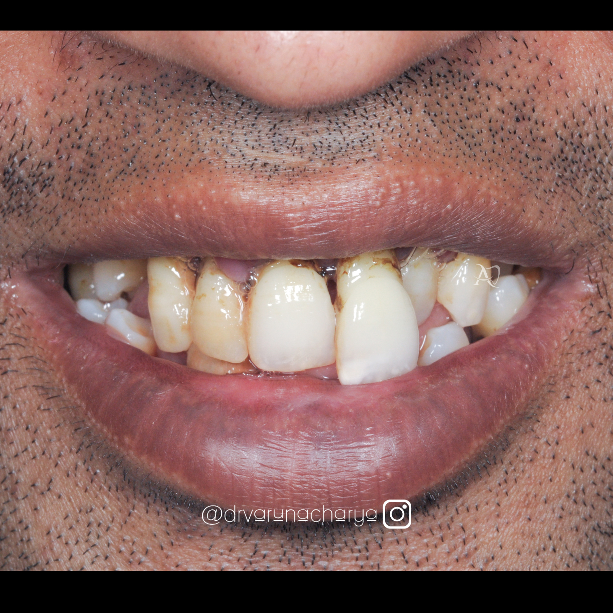 before full mouth rehabilitation