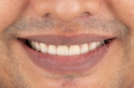 after full mouth rehabilitation