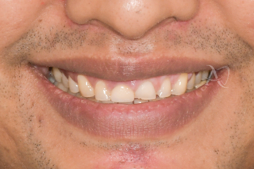 before full mouth rehabilitation